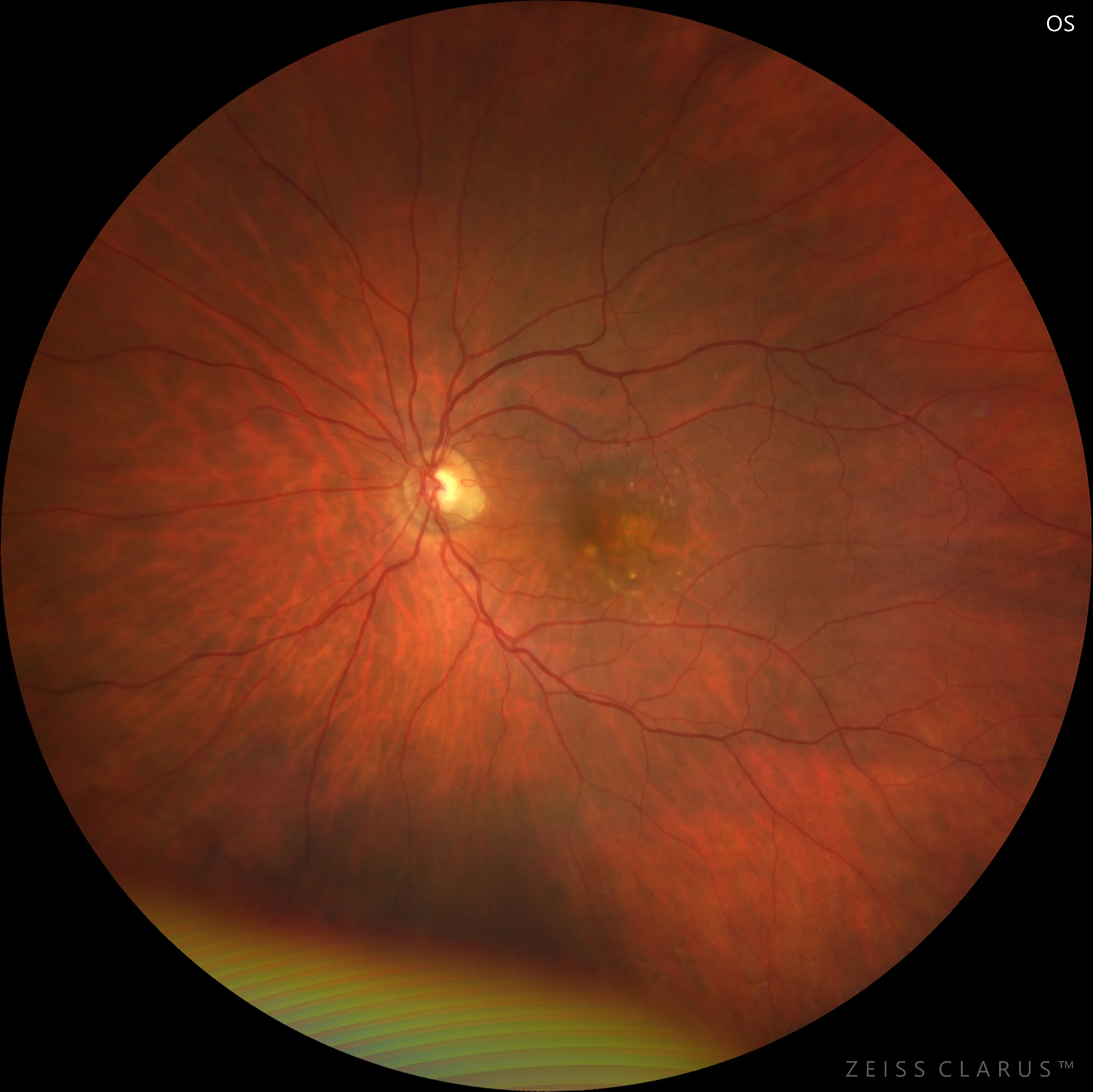 Retinal imaging of the patient’s better-seeing eye showing mild structural changes but no new membrane formation.