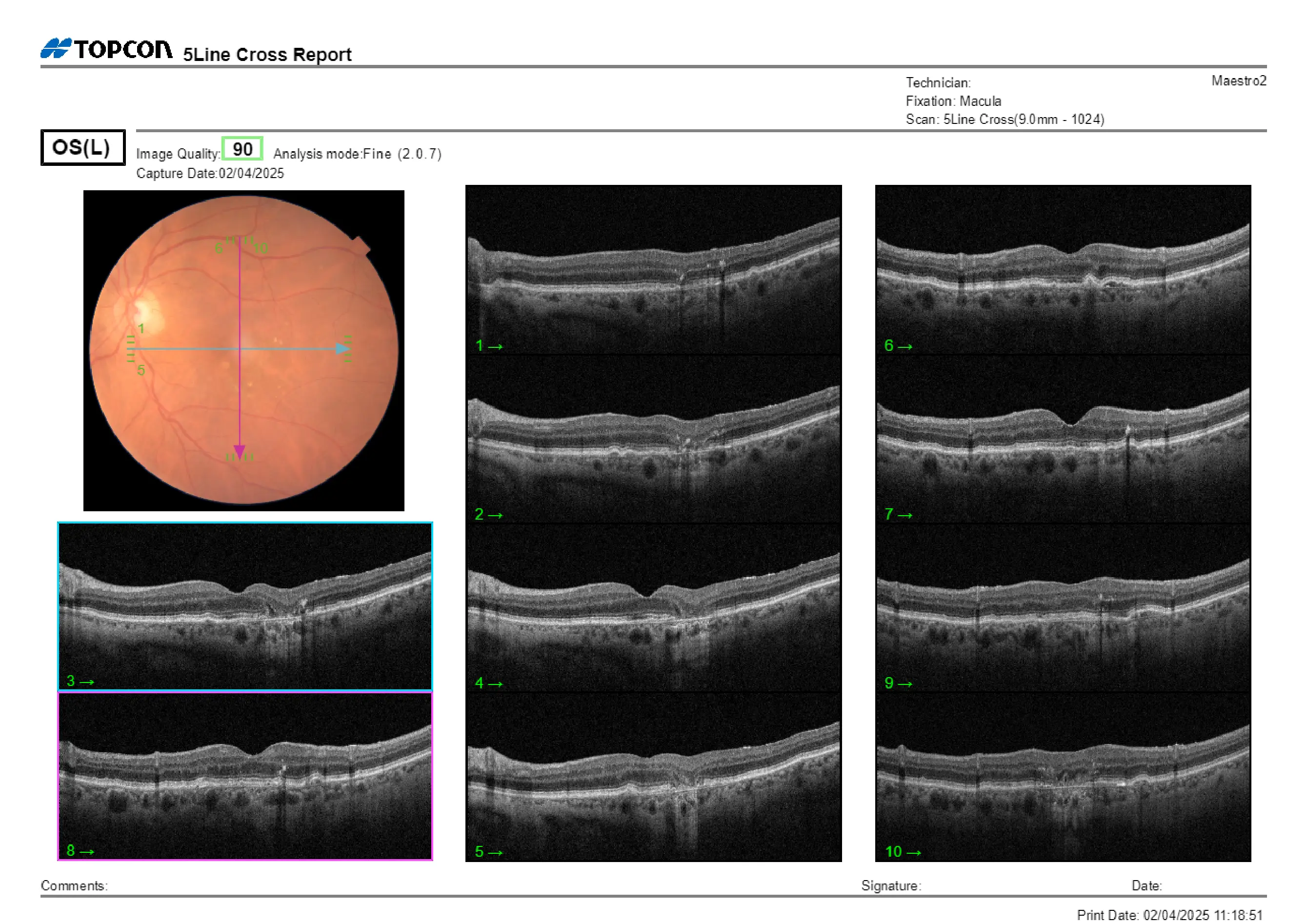 Monitoring image highlighting the need for ongoing surveillance of dry age-related macular degeneration progression.