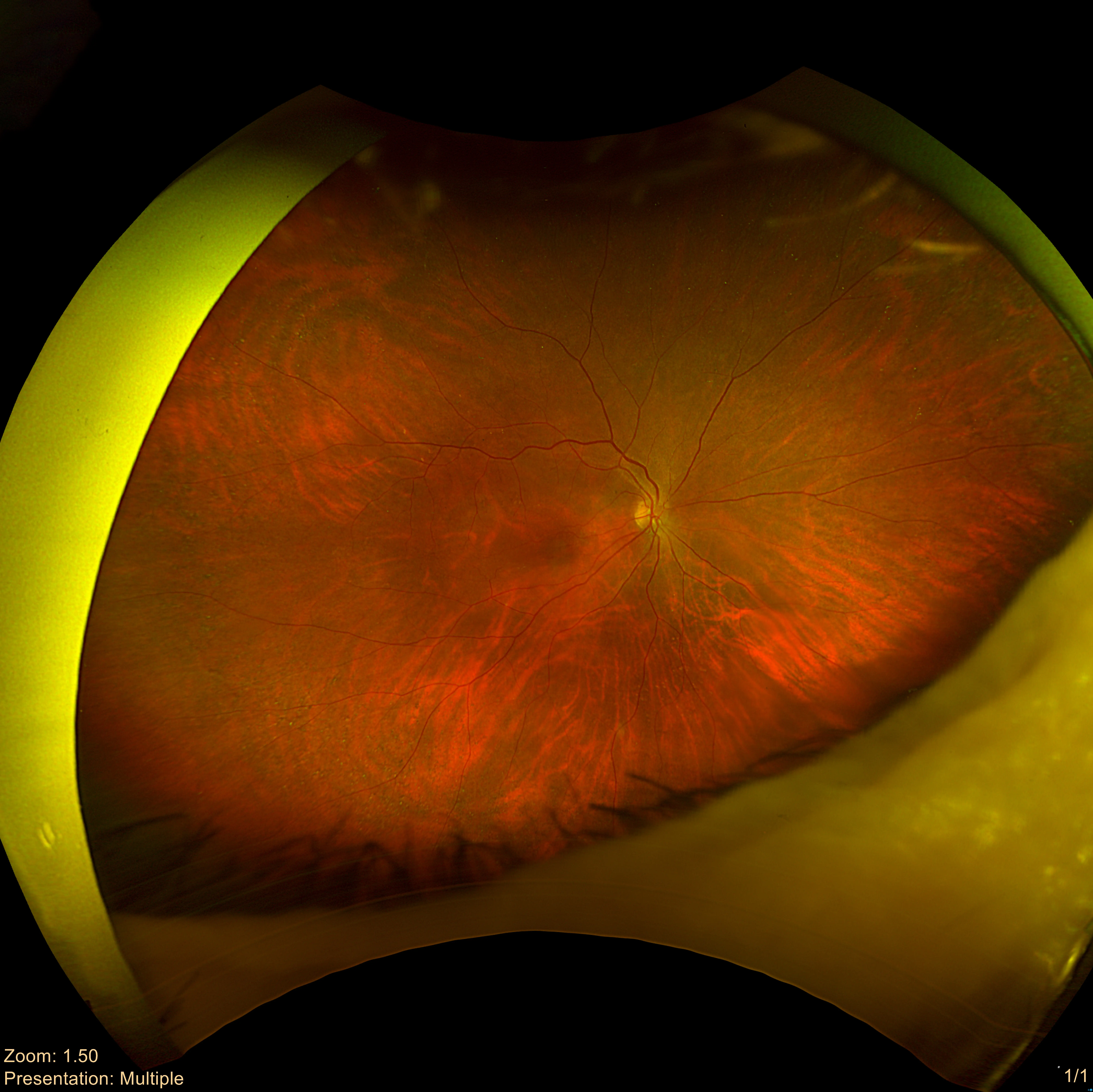 Right eye retinal photo from a Care1 case study.