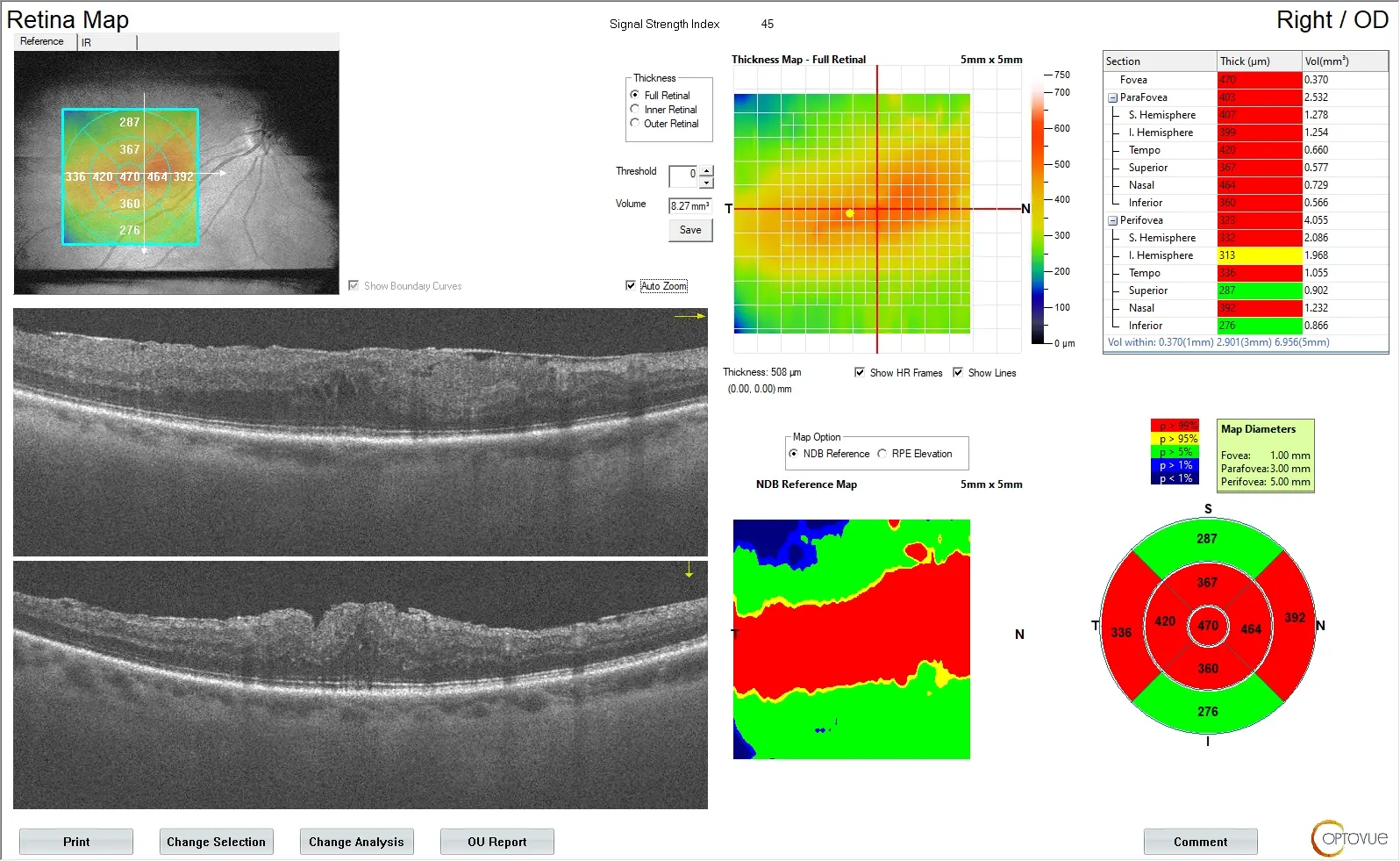 Progressive Vision Loss and Macular Changes in One Eye