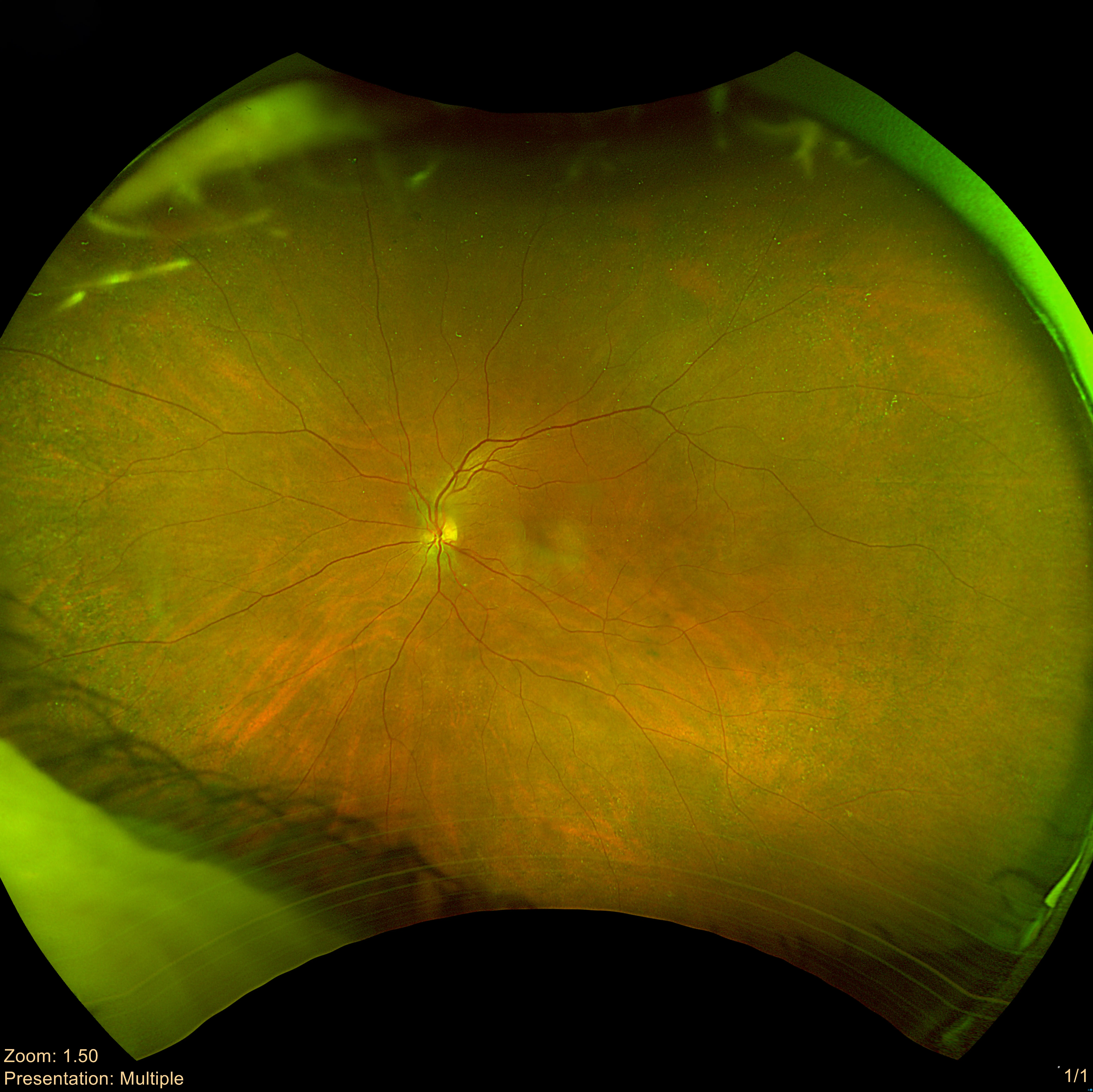 Left eye retinal photo from a Care1 case study.