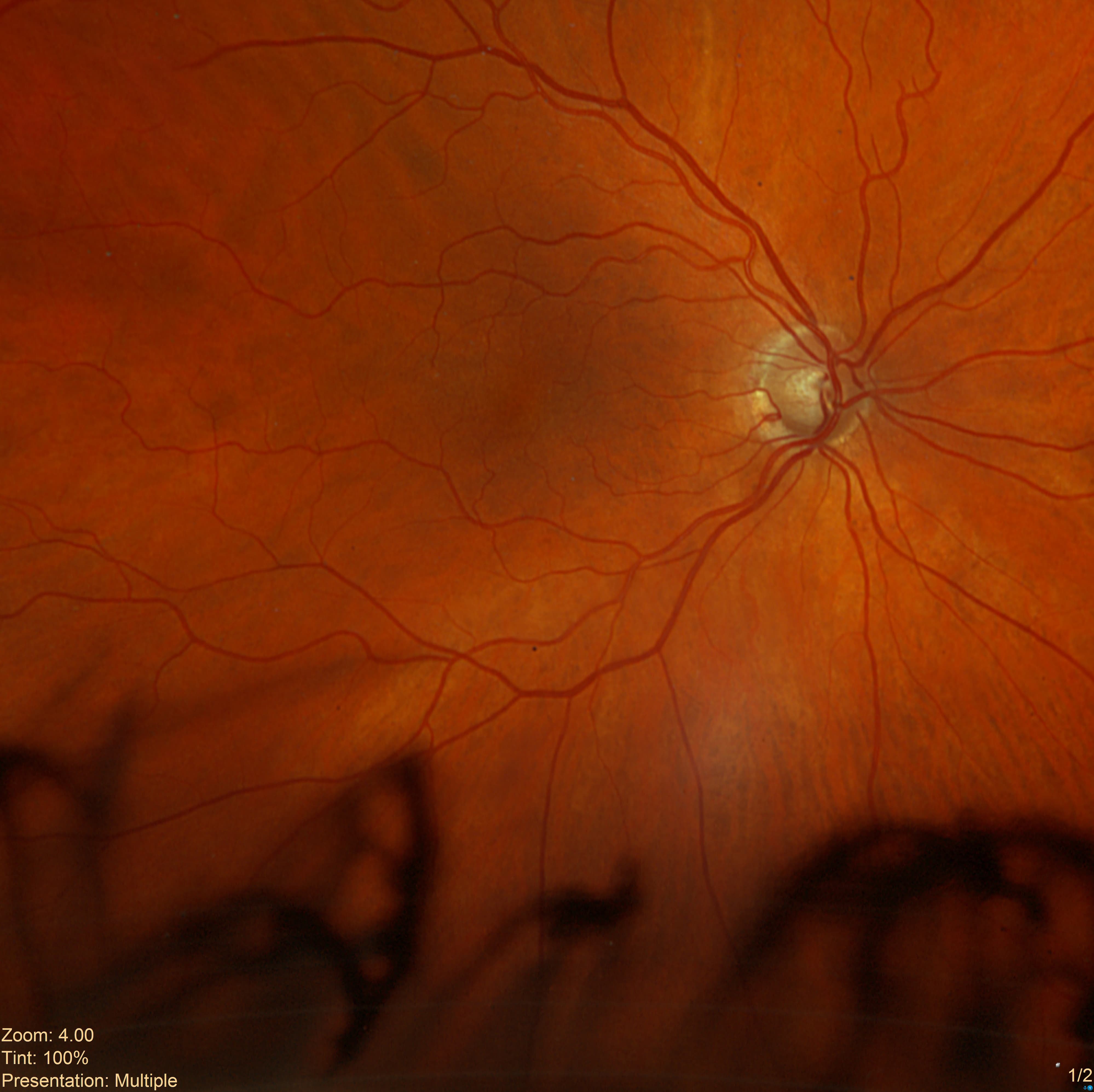 Stable Optic Nerve Changes With Mild Superior Visual Field Defects
