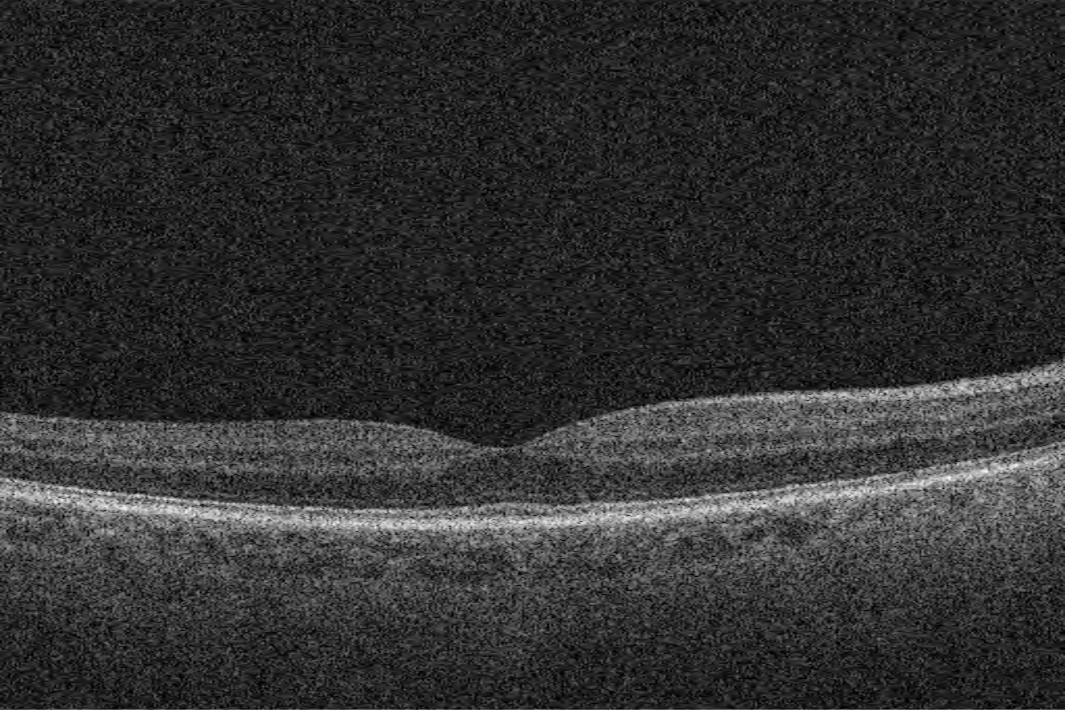 Right eye macular OCT scan from Care1