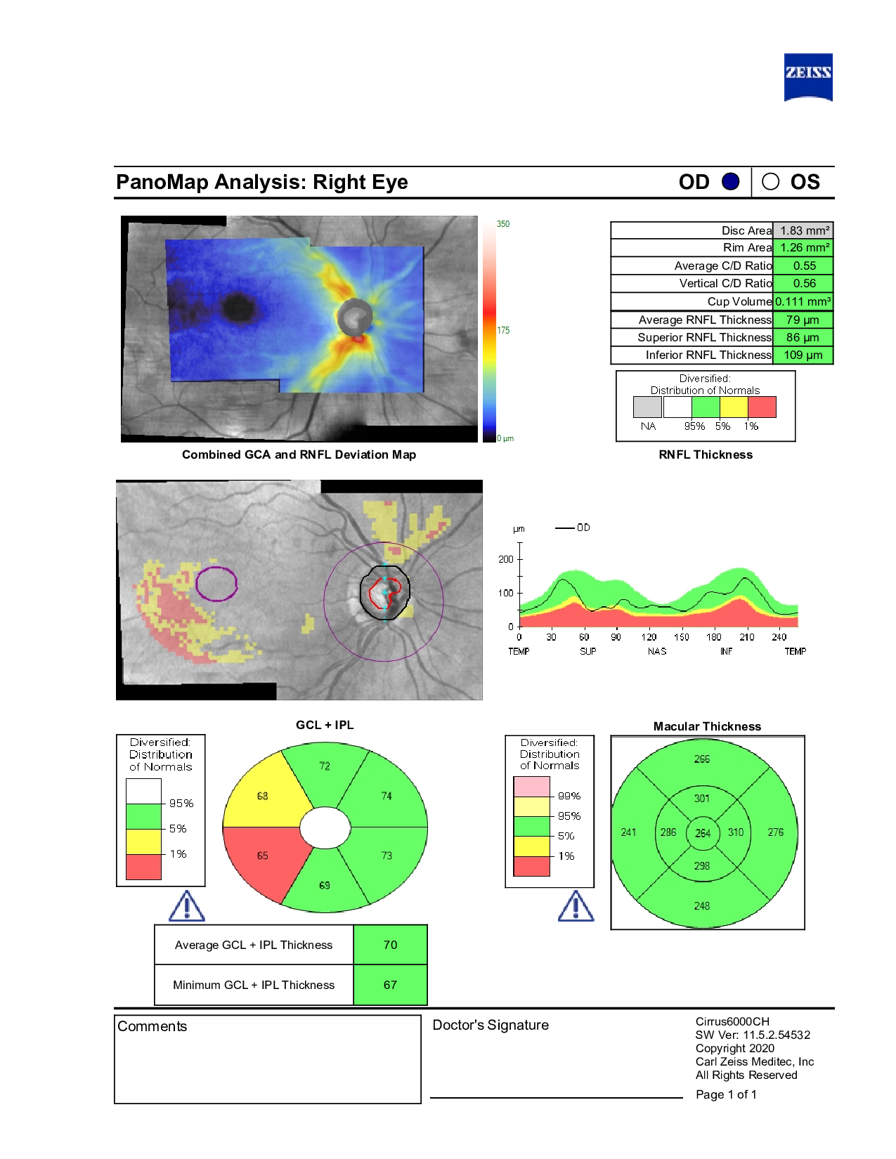Right eye OCT RNFL report from Care1