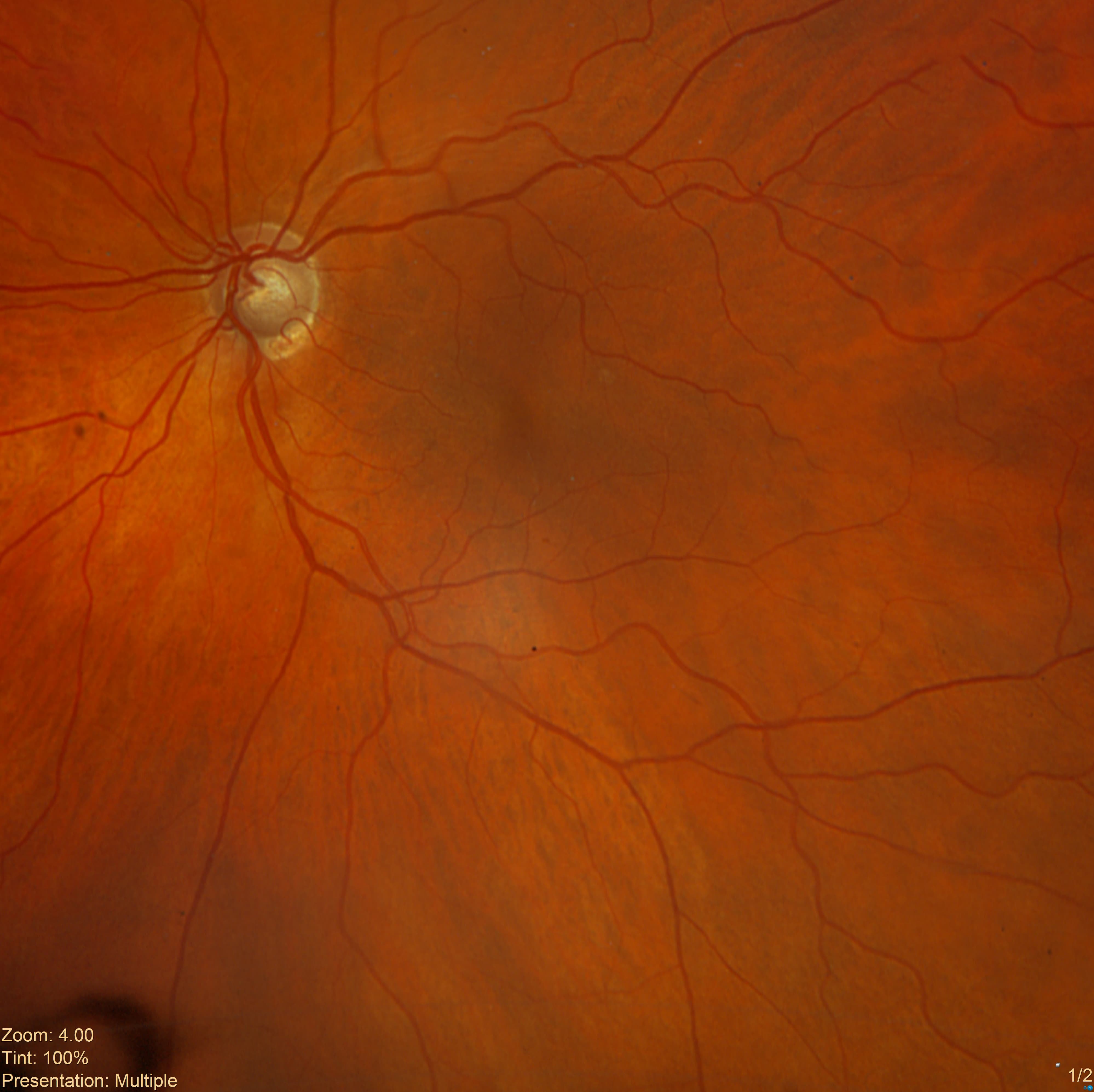 Stable Optic Nerve Changes With Mild Superior Visual Field Defects