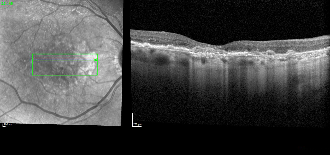 Progressive Vision Changes with Subretinal Deposits and Atrophy in the Left Eye
