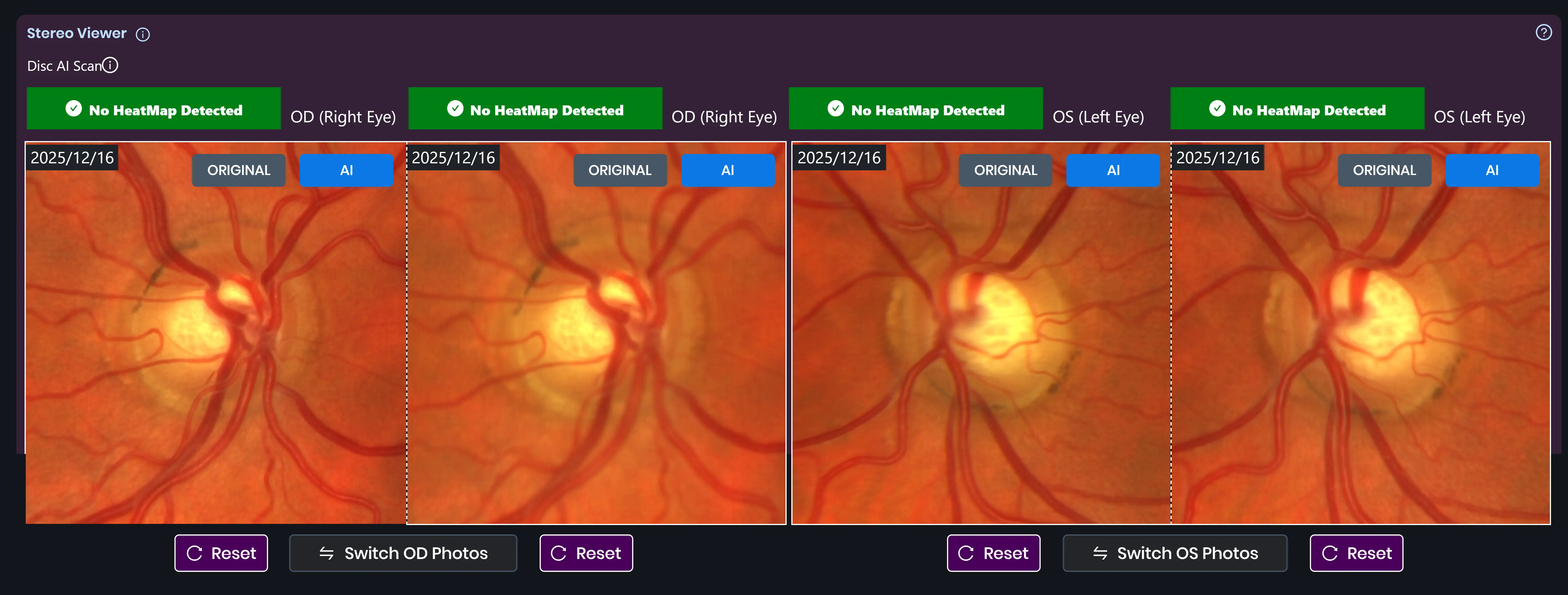 See the Optic Nerve in 3D