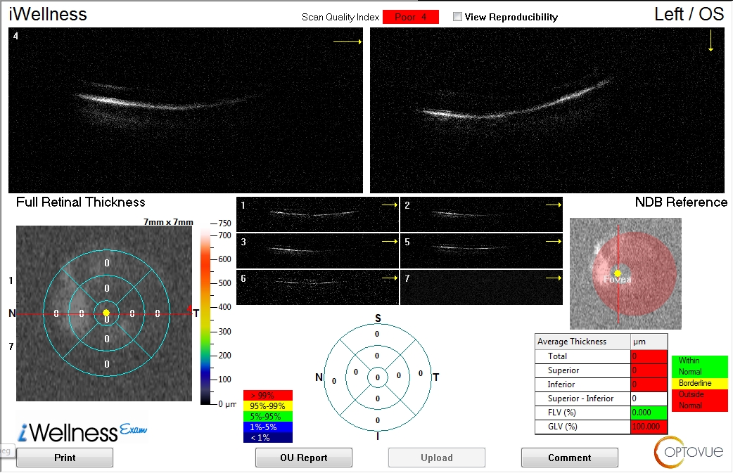 Case Study: Longstanding Field Defect With Stable Low Pressures