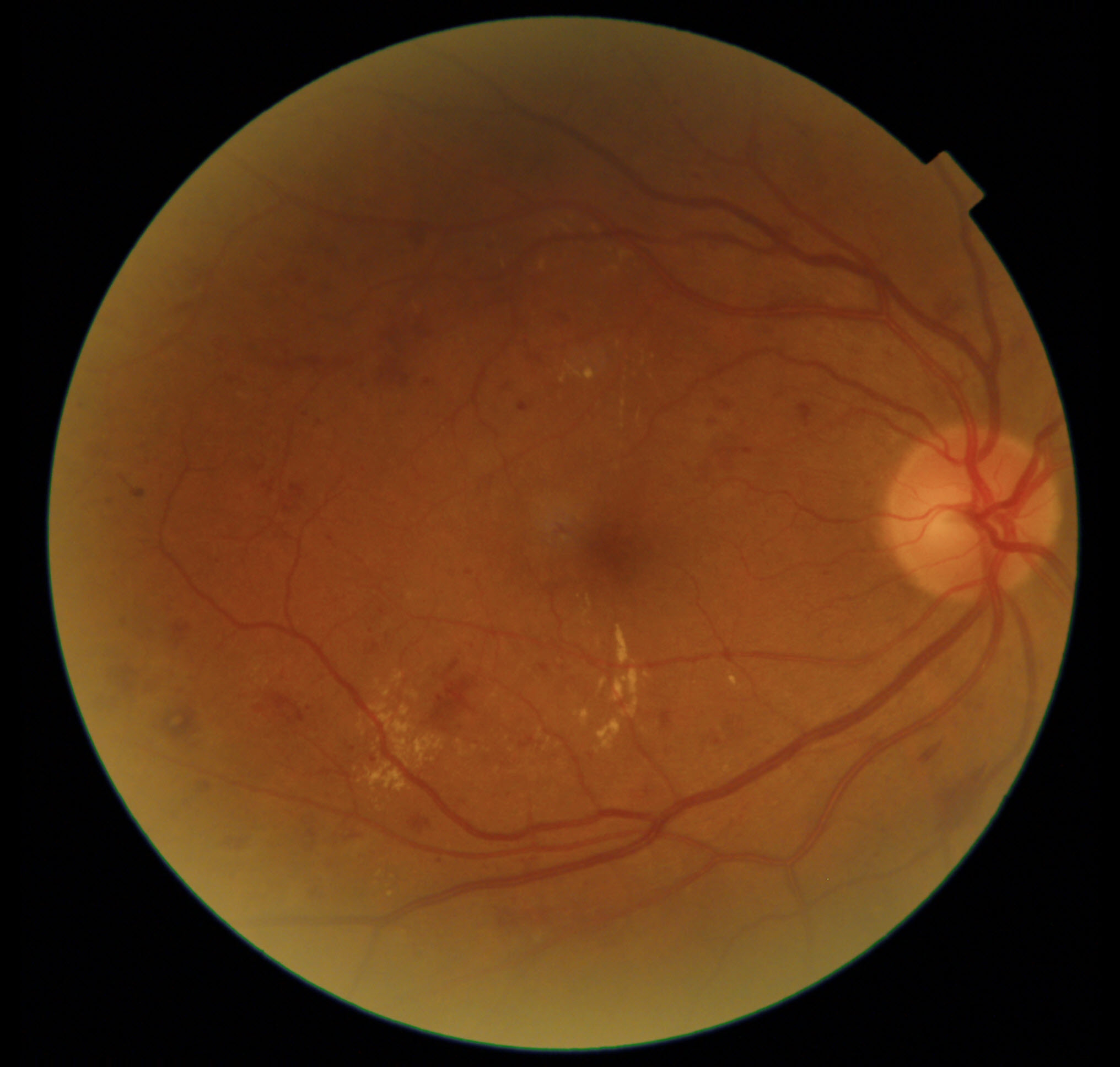 Follow-Up for Chronic Retinal Changes in a Longstanding Diabetic Patient