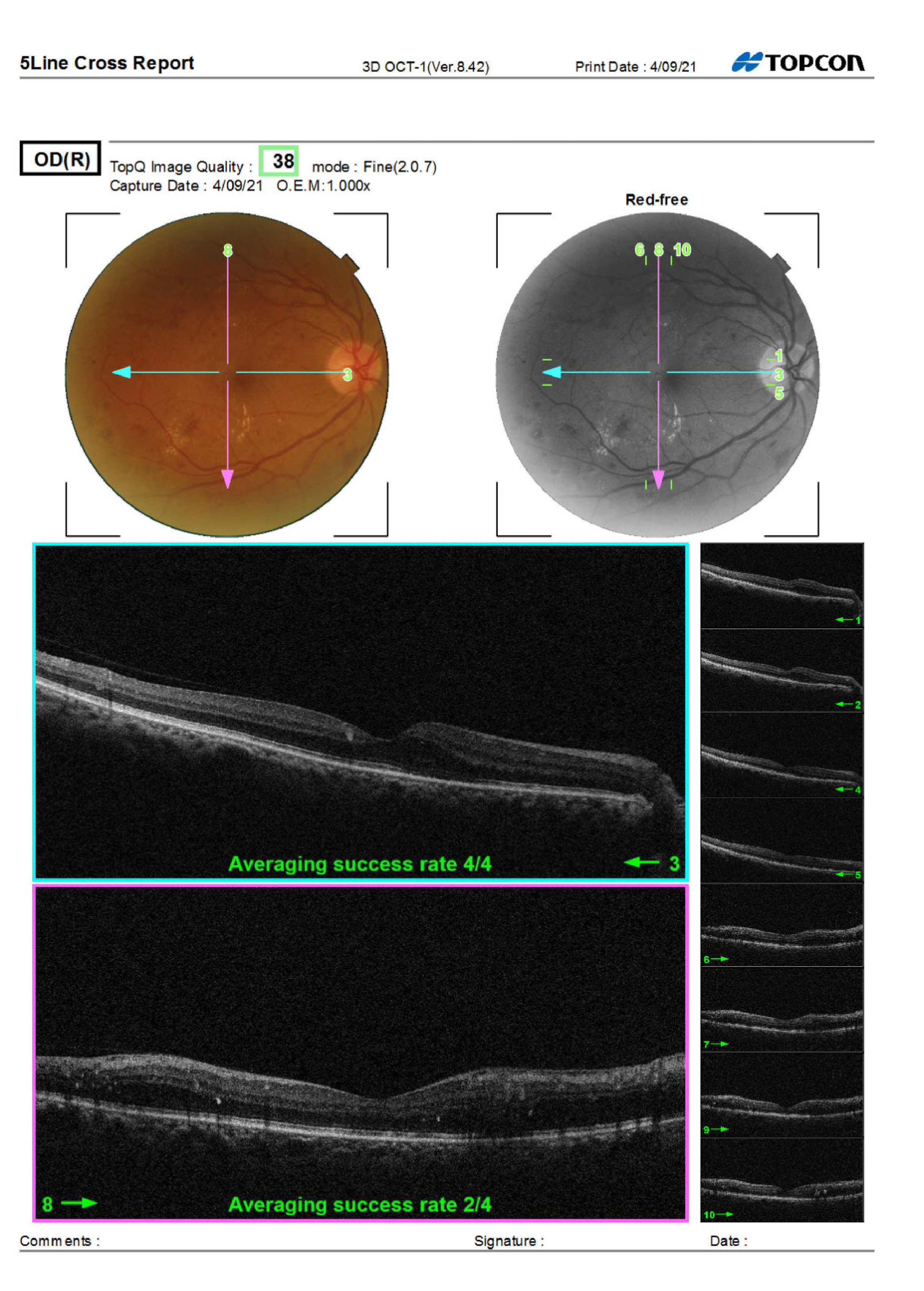 OD OCT Macula from Care1 case study.