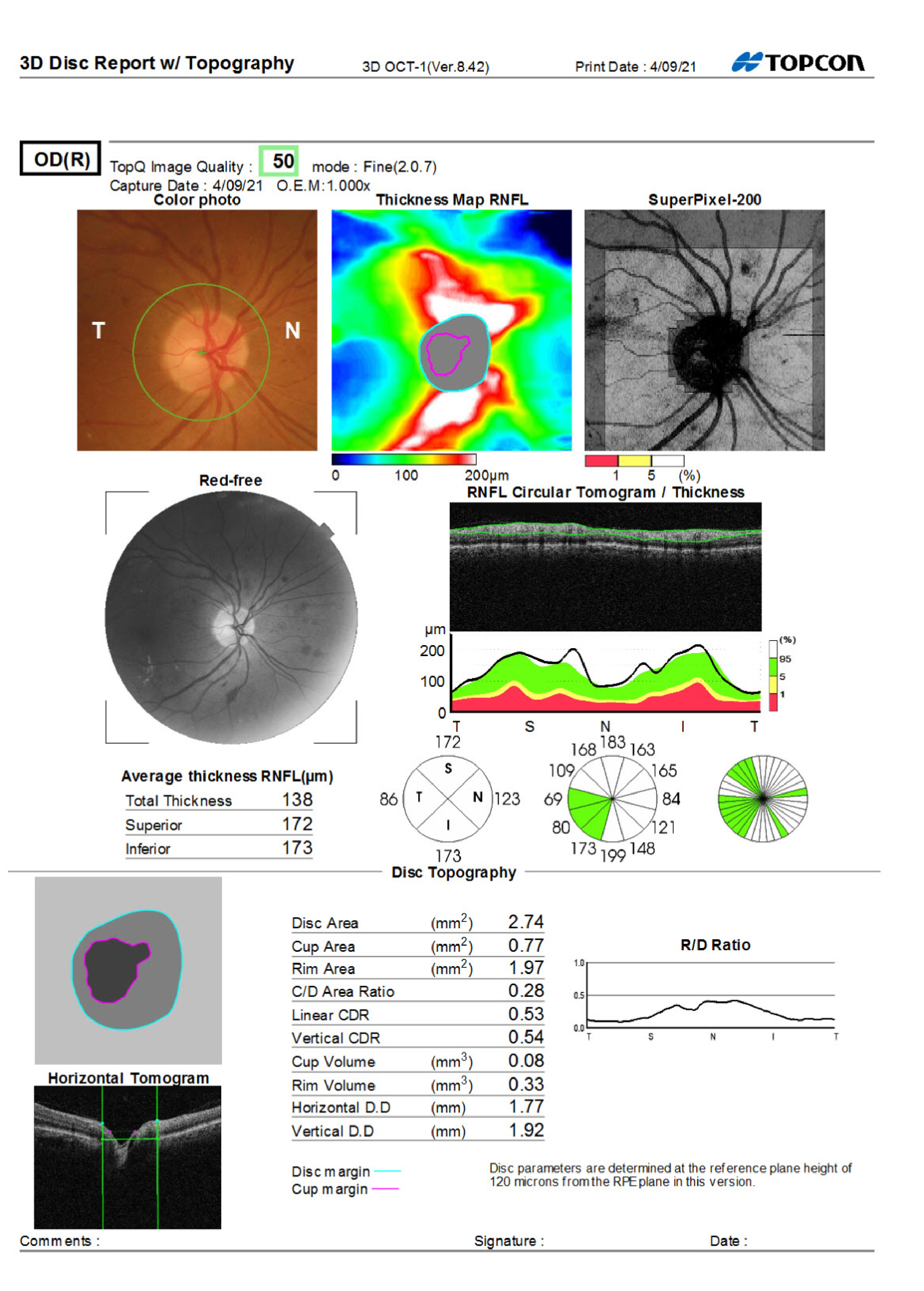 OD OCT RNFL from Care1 case study.