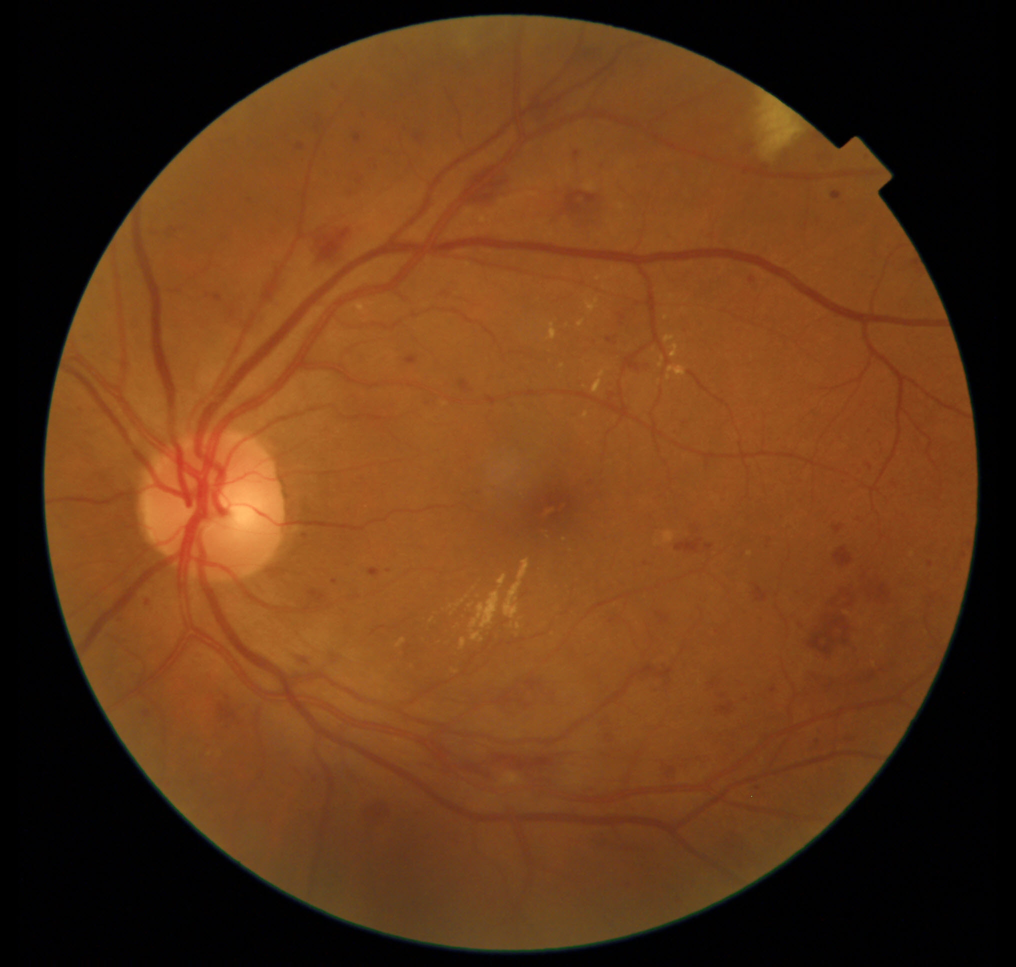 OS Fundus Photo from Care1 case study.