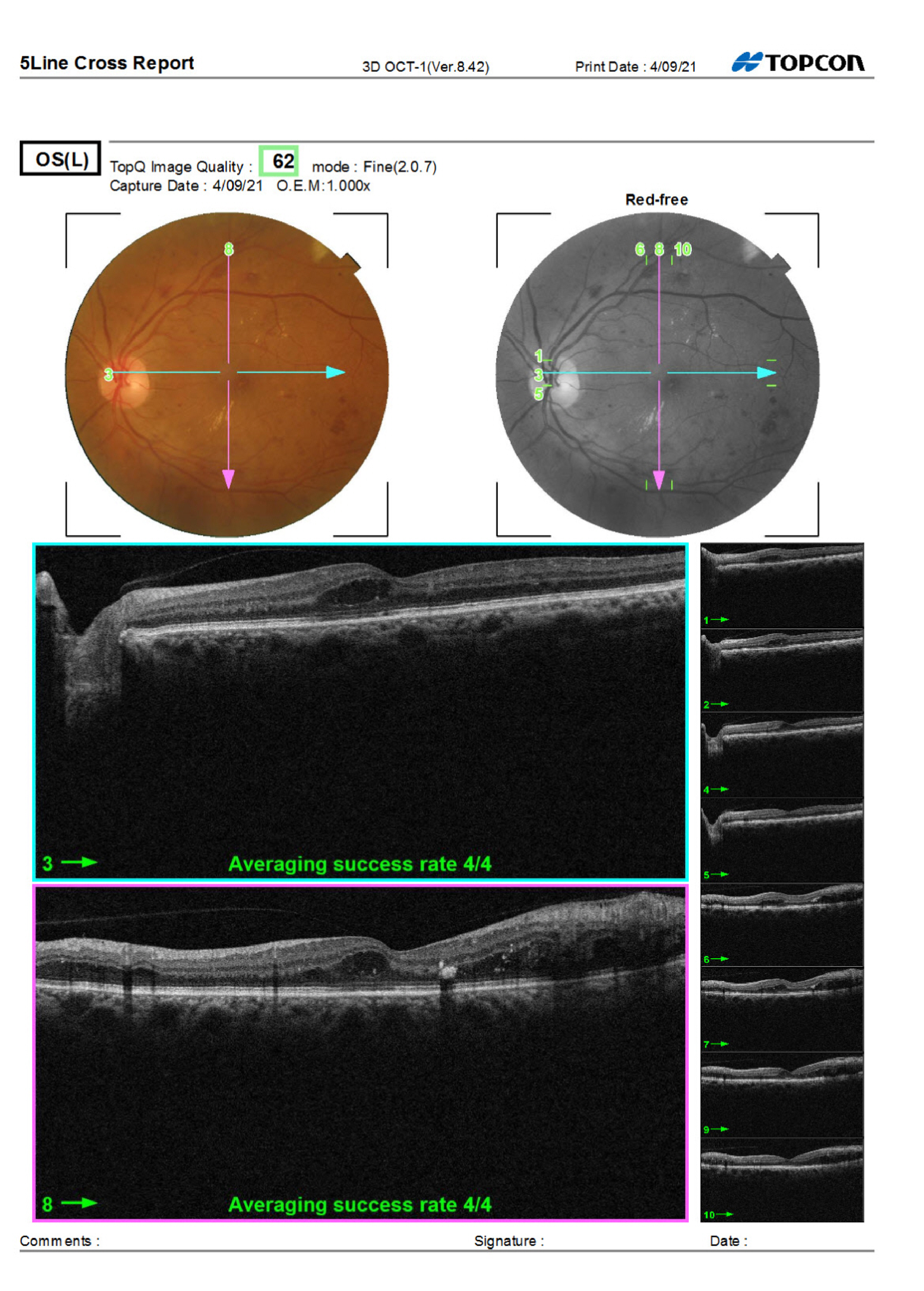 OS OCT Macula from Care1 case study.