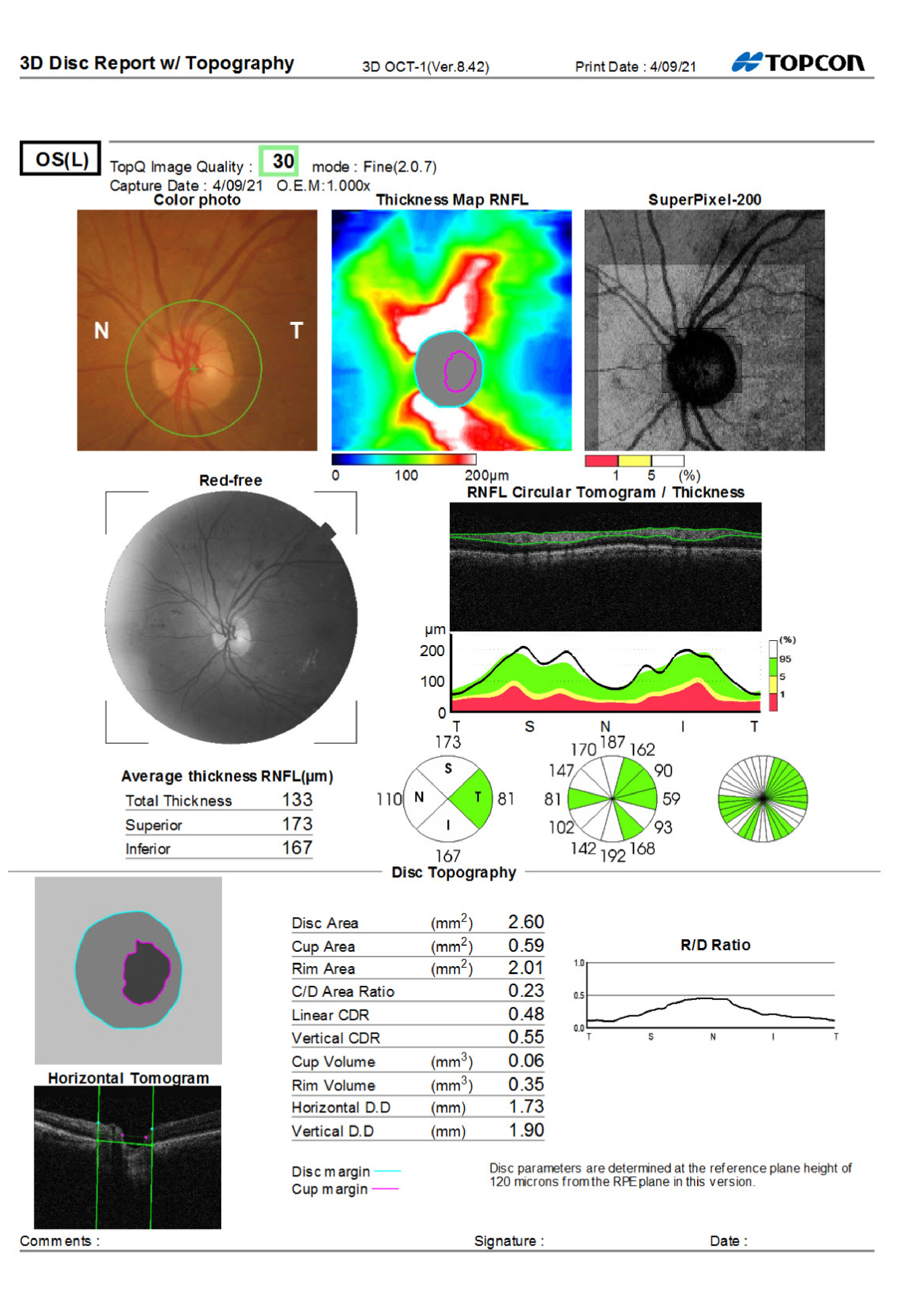 OS OCT RNFL from Care1 case study.
