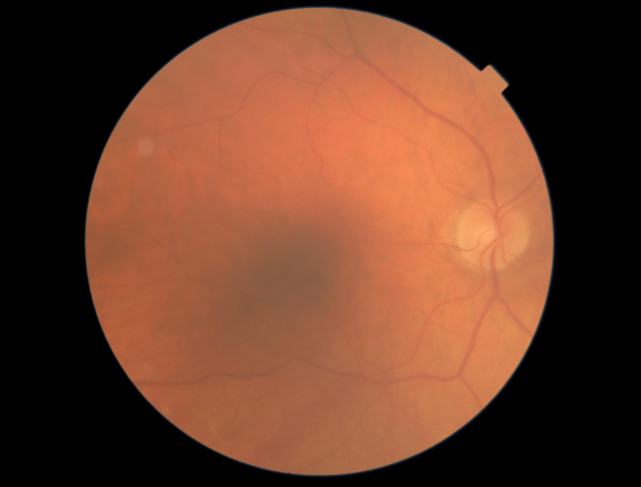 Case Study: Retinal Changes and Vision Monitoring