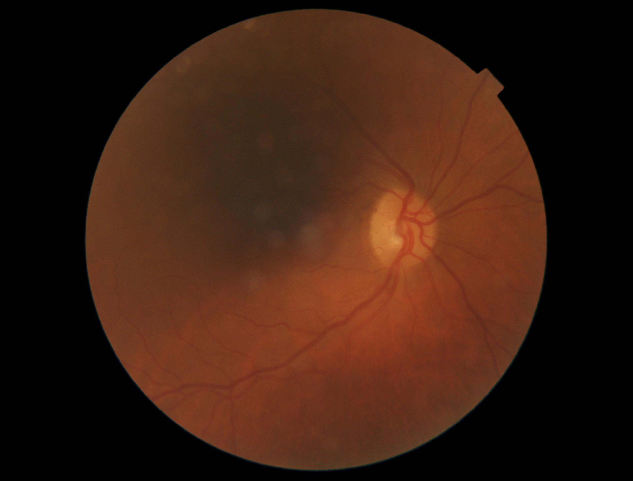 Case Study: Mild Macular Changes