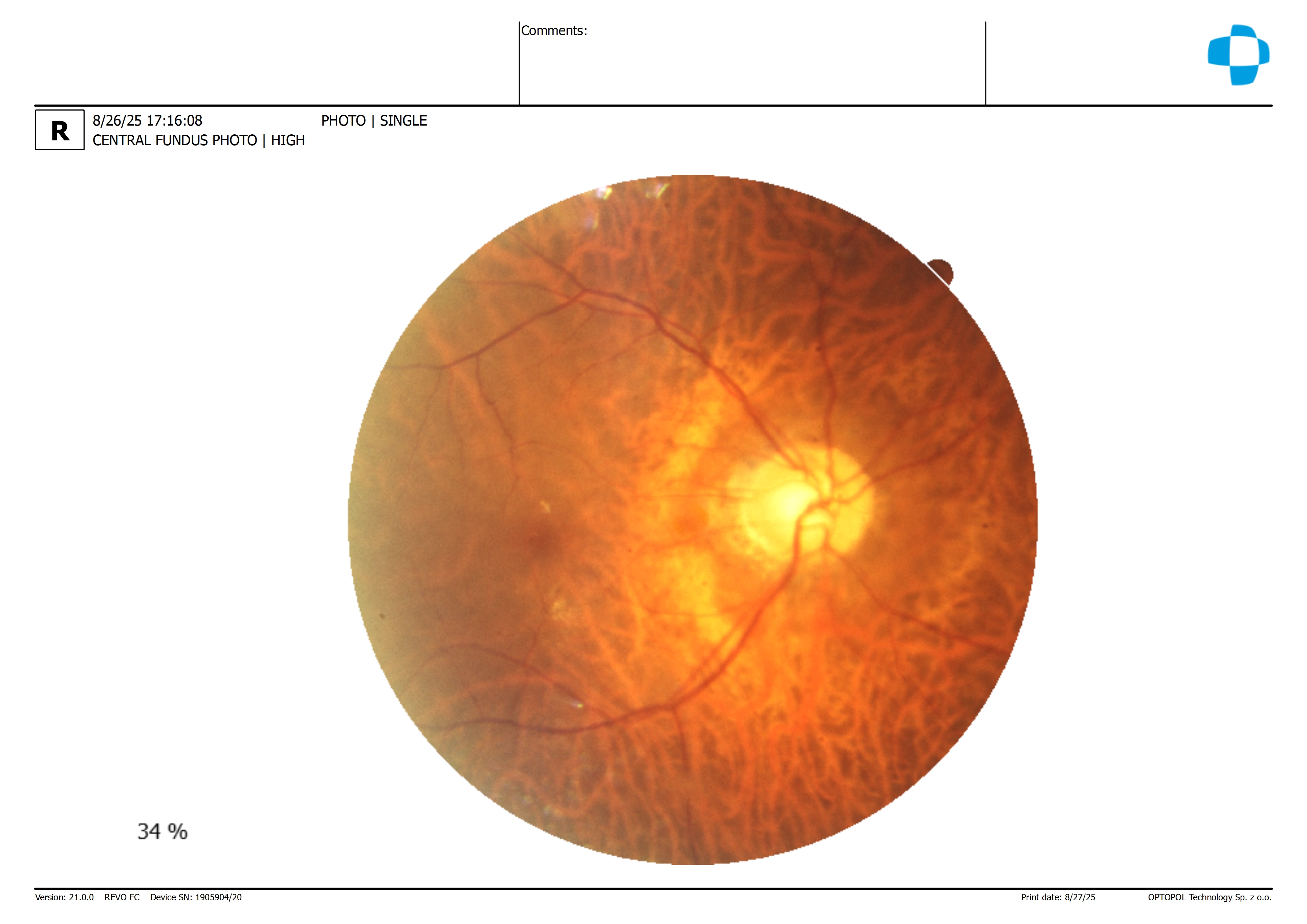 Case Study: Elevated Pressures with Myopic Discs