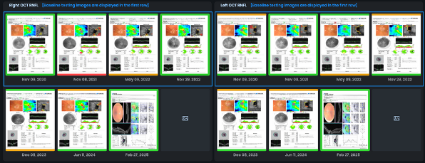 AI-generated OCT RNFL longitudinal trend chart showing glaucoma stability.