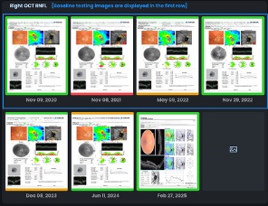 AI-Powered OCT RNFL Trend Analysis: A Smarter Way to Monitor Glaucoma with Care1