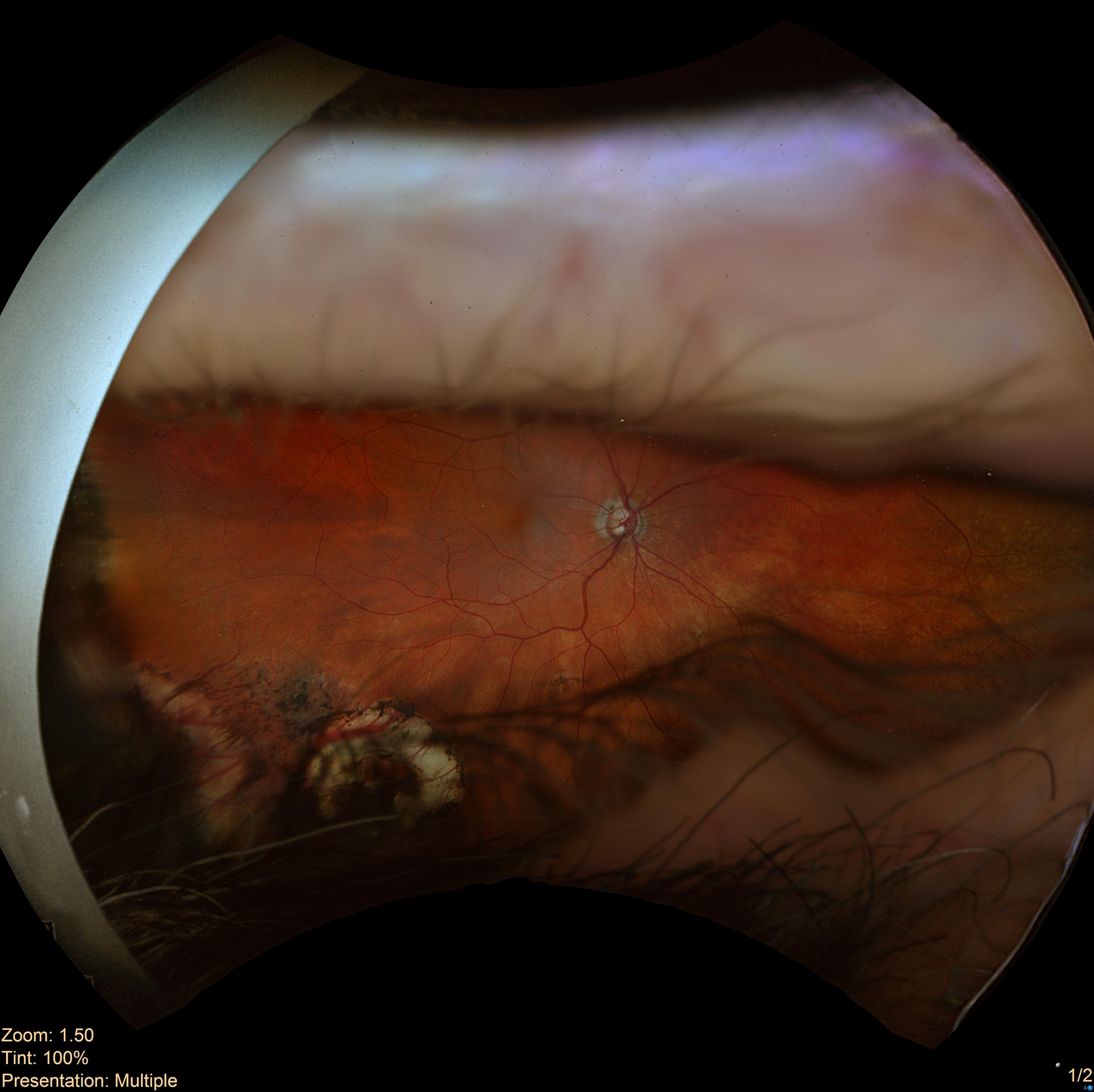 Case Study: Elevated Eye Pressures and Optic Changes