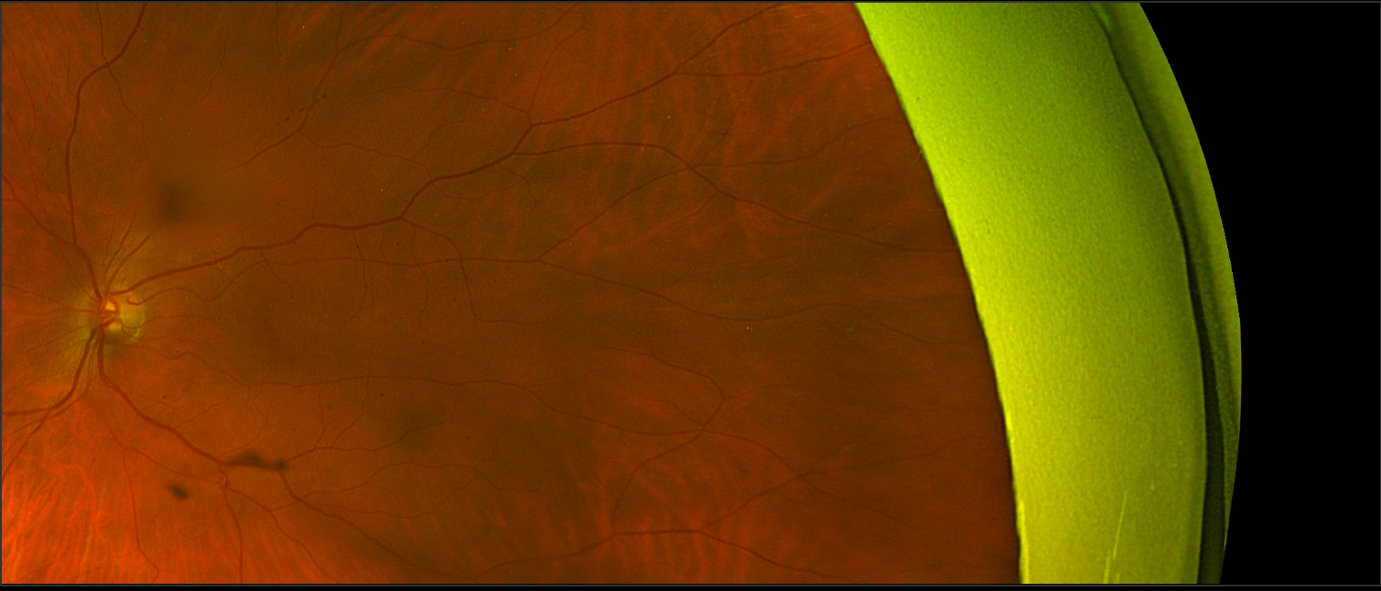 Case Study: Stable Vision with Lamellar Hole