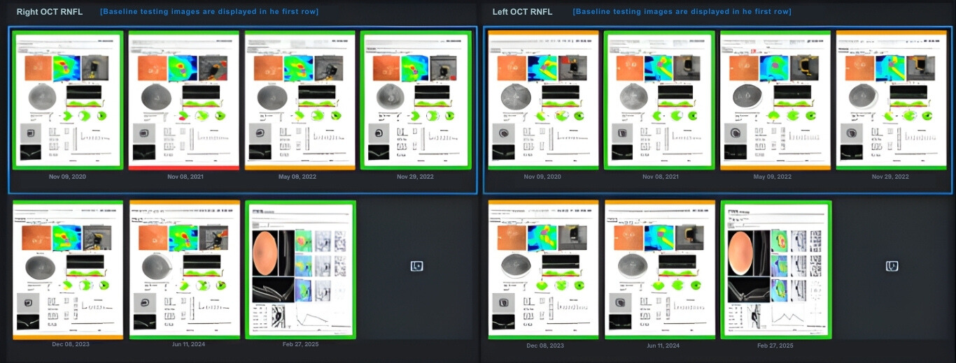 AI-Powered OCT RNFL Trend Analysis: A Smarter Way to Monitor Glaucoma with Care1
