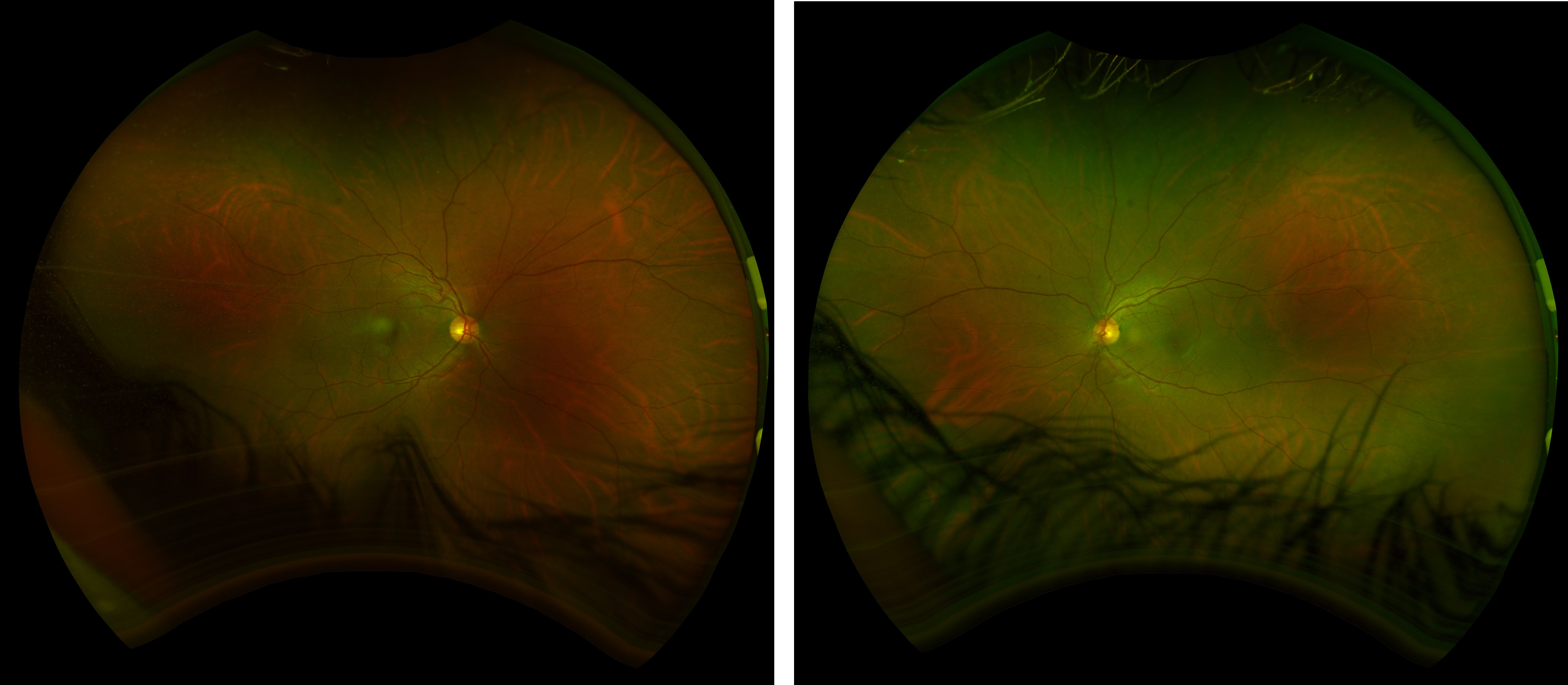 Case Study: Central Serous Retinopathy
