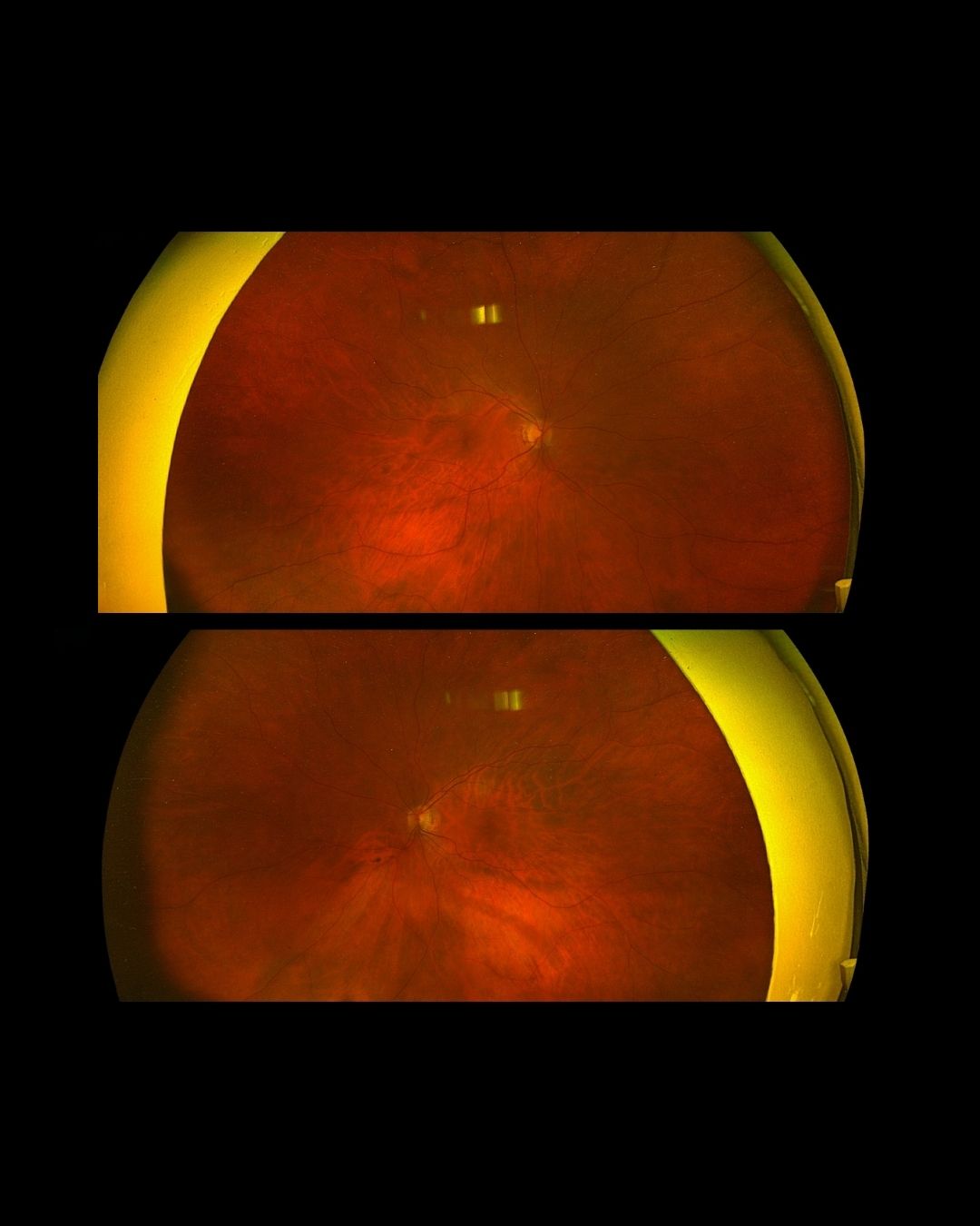 Case Study: Reduced Visual Acuity OD with Foveal Irregularity and Early Cataract
