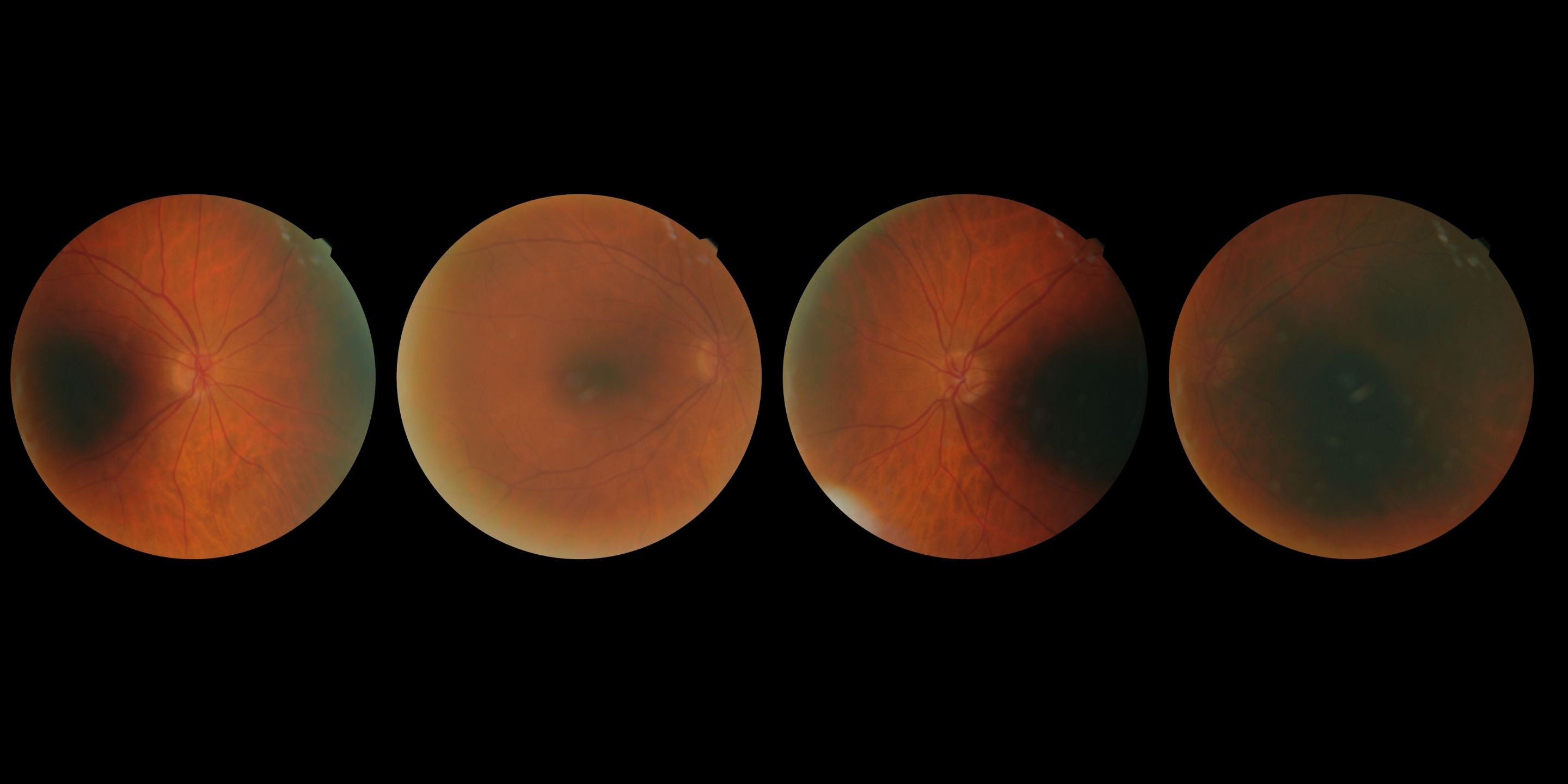 Case Study: Glaucoma Suspect with Strong Family History and Thick Corneas
