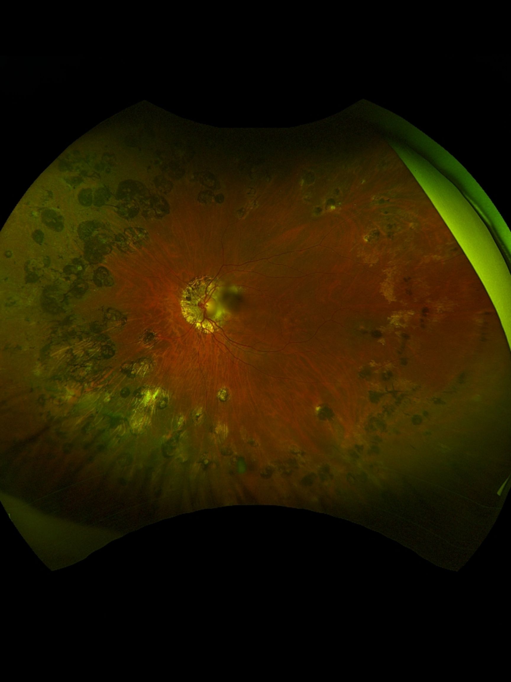 Case Study: Unilateral Macular PED With Edema