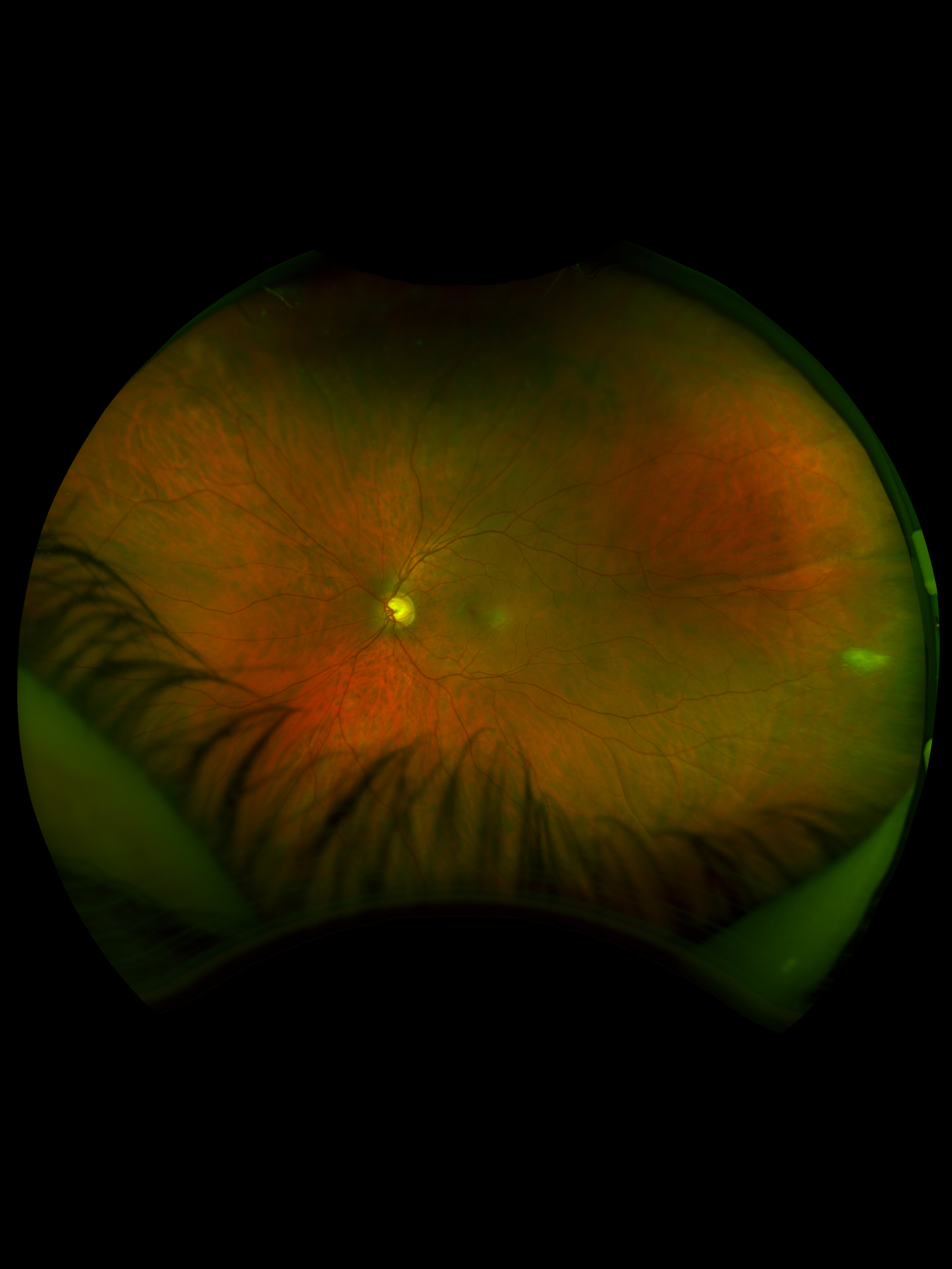 Case Study: Large Temporal Vitreous Tuft