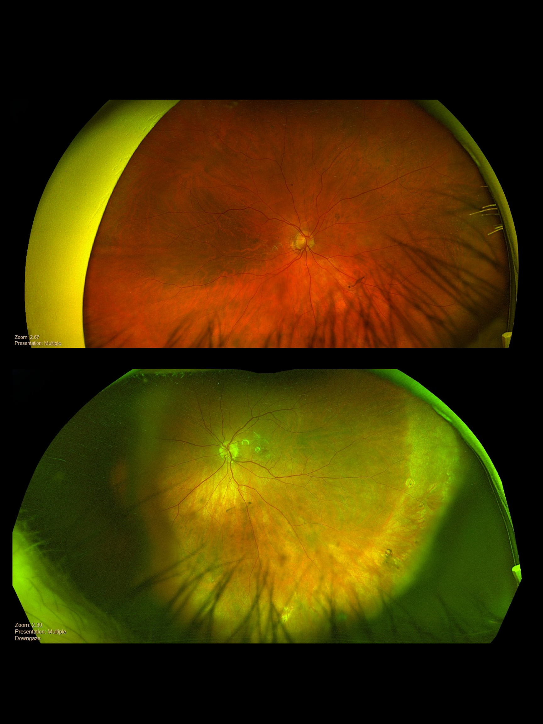 Case Study: Peripheral Retinal Lesion Concern