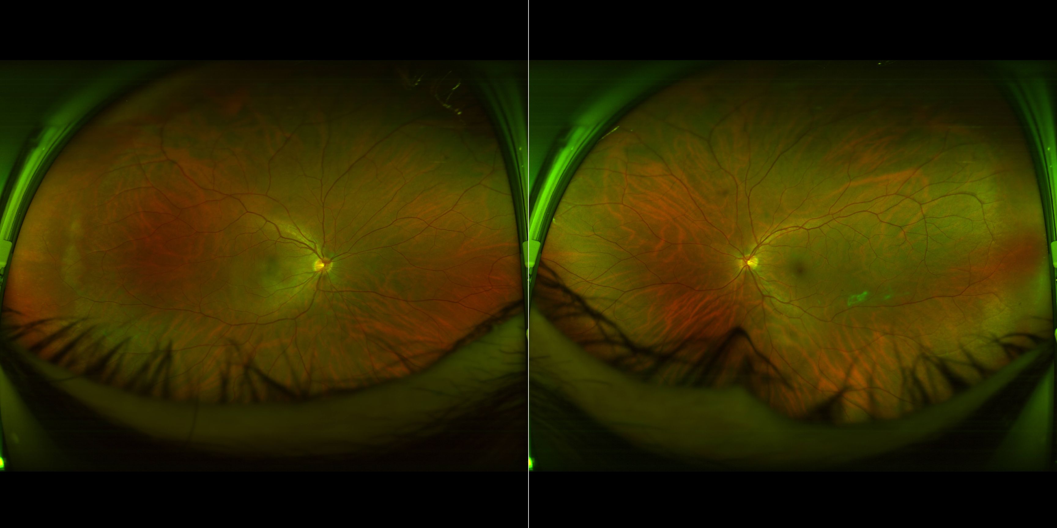 Case Study: Persistent Floaters Blurred Vision