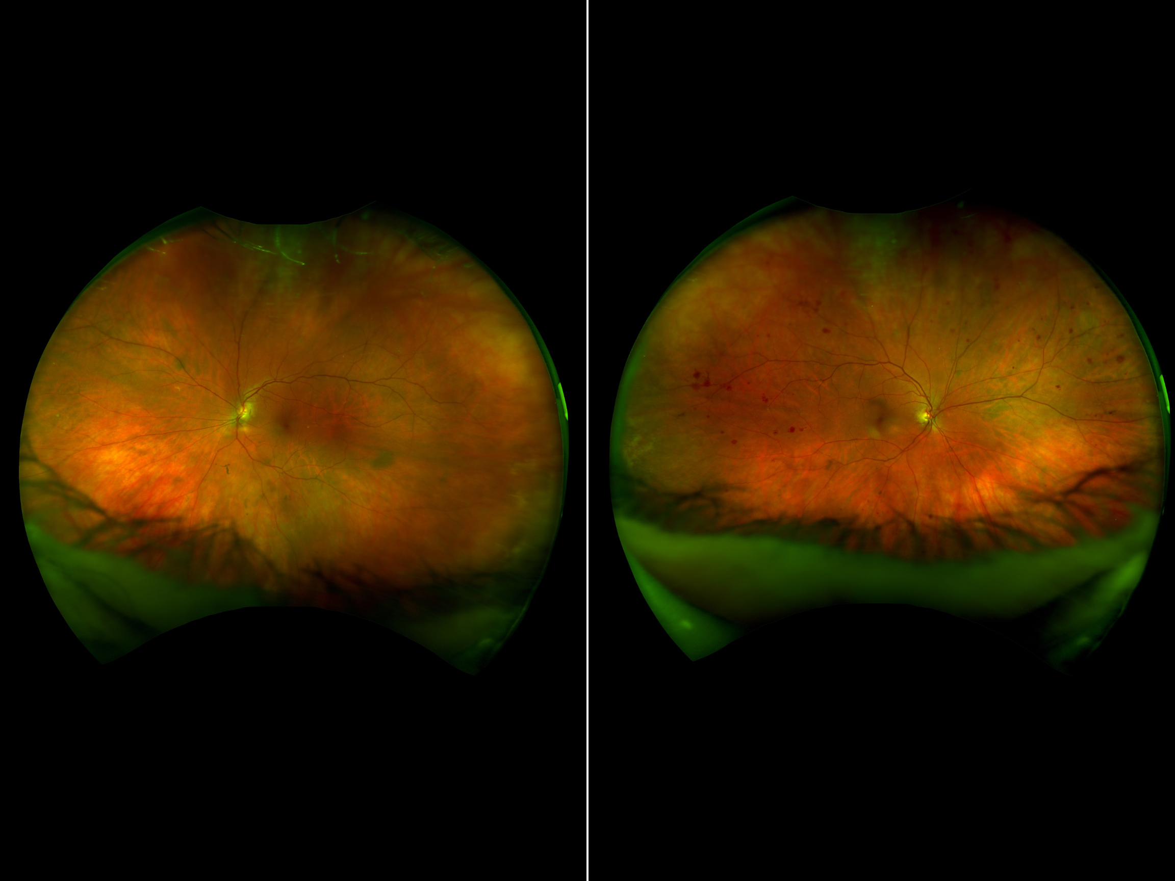 Case Study: Unilateral Retinal Hemorrhages