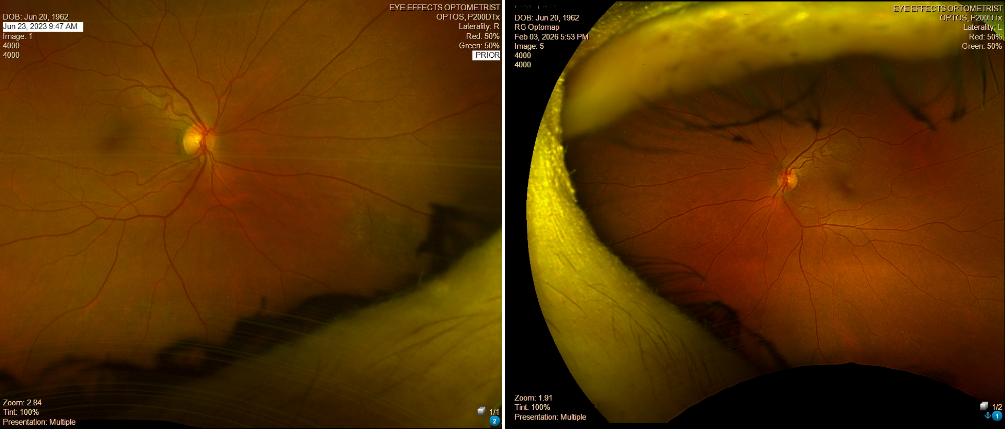 Case Study: Nasal Retinal Change Progression