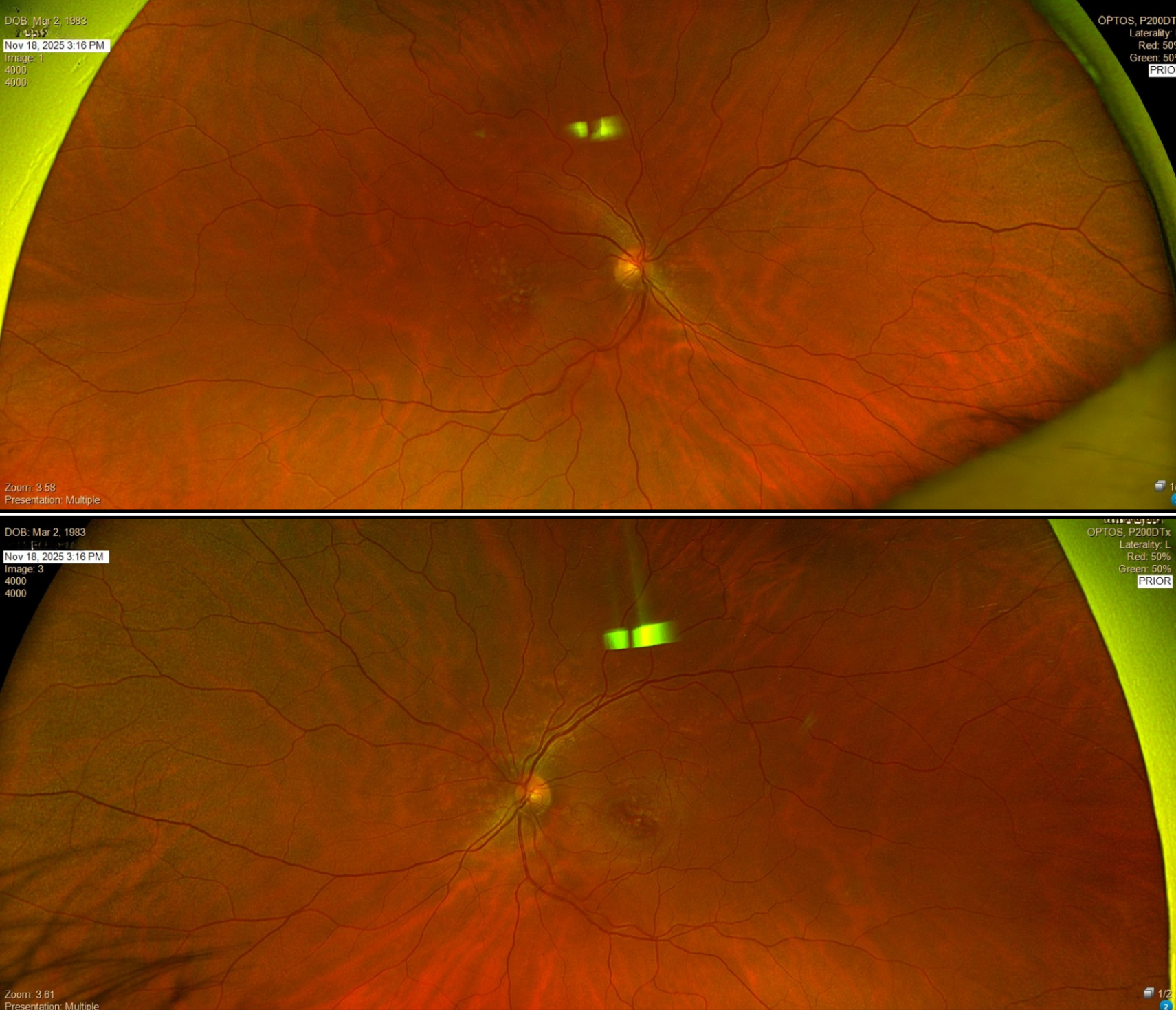 Case Study: Bilateral Drusen in Young Adult