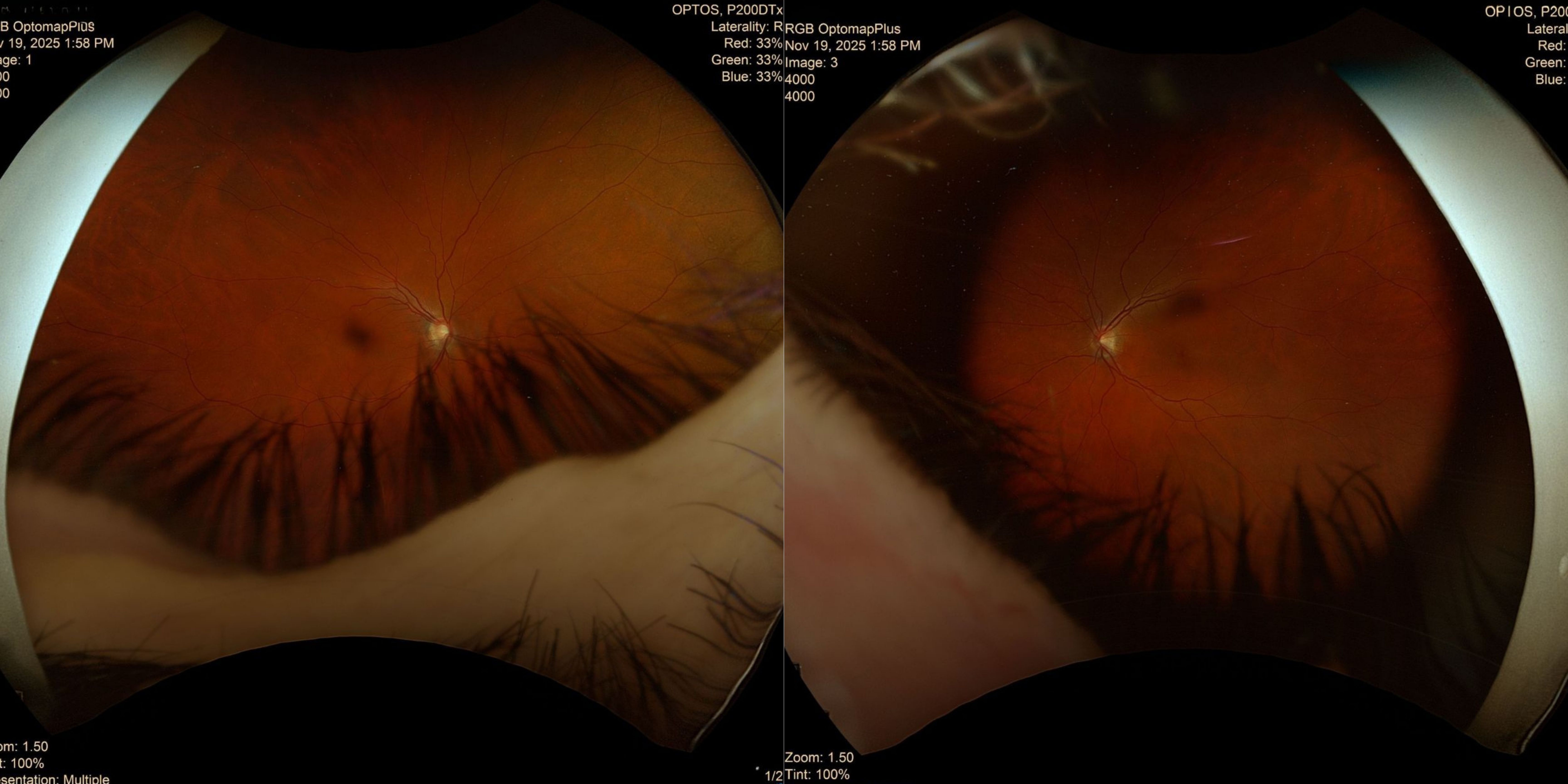 Case Study: Asymmetric Optic Nerve Cupping