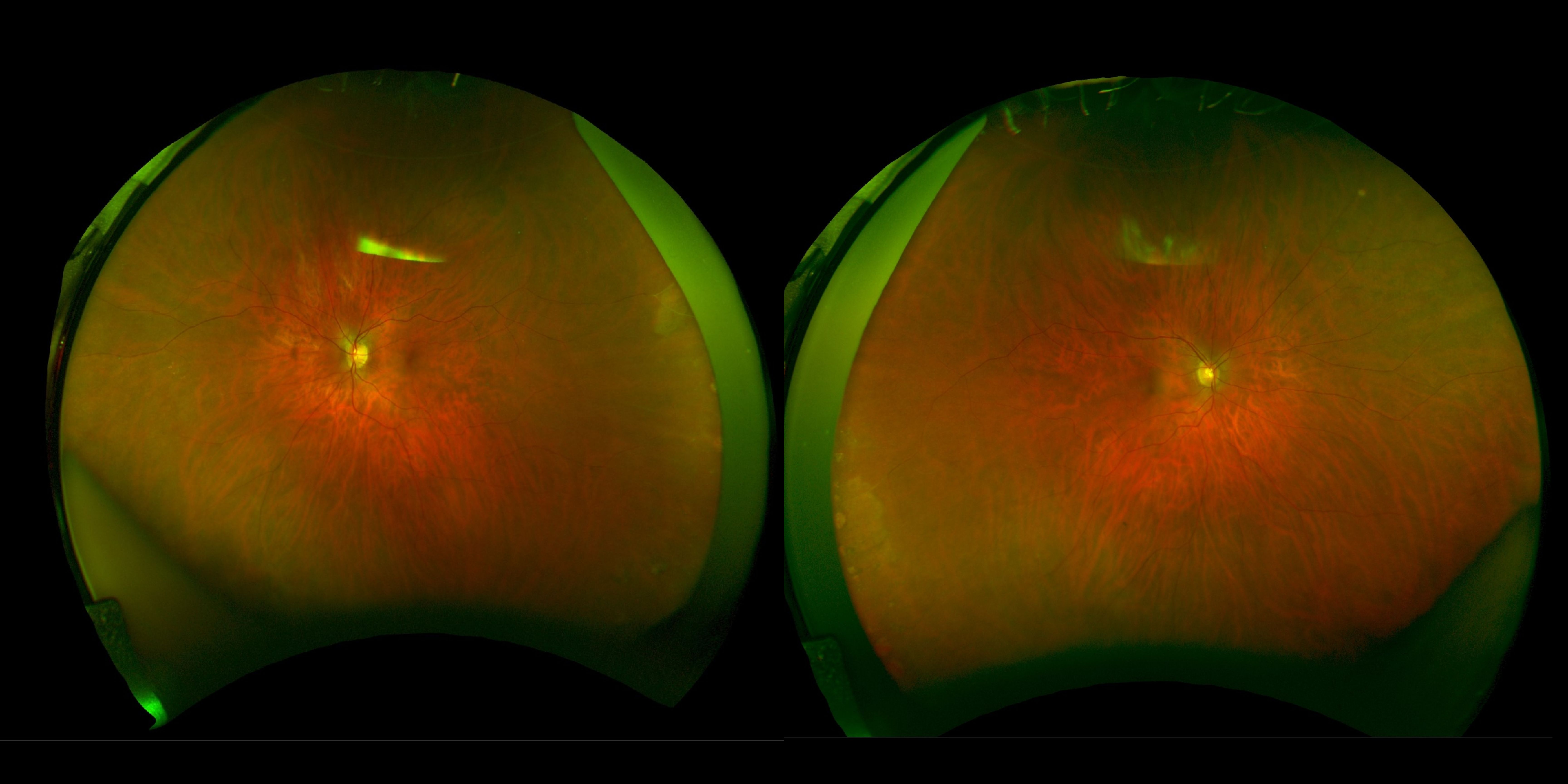 Case Study: Long-Term Plaquenil With Stable Retina