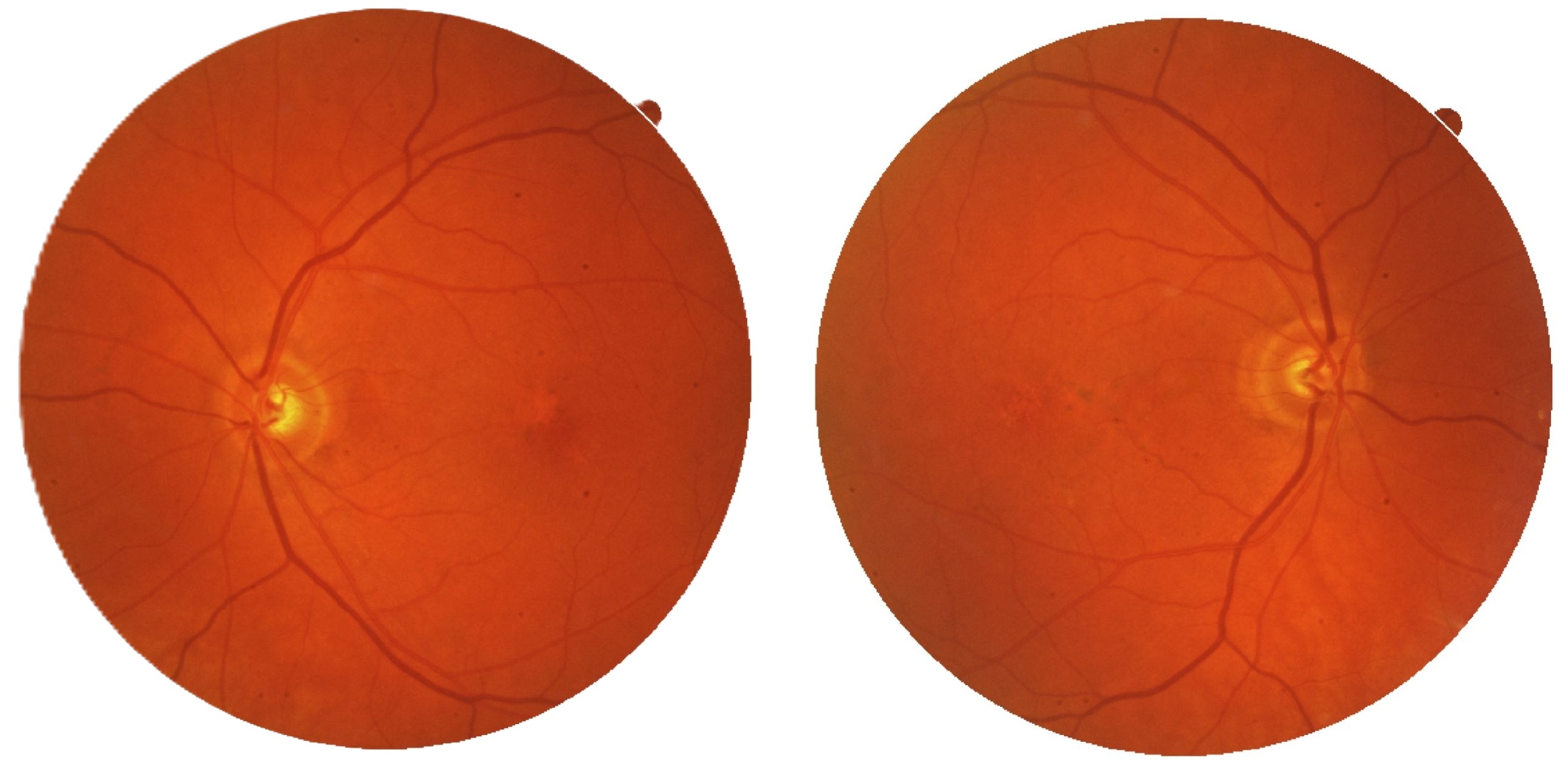 Case Study: Trace Subretinal Fluid With 20/20 Vision 