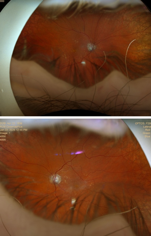 Case Study: Large Cupping With Normal VF