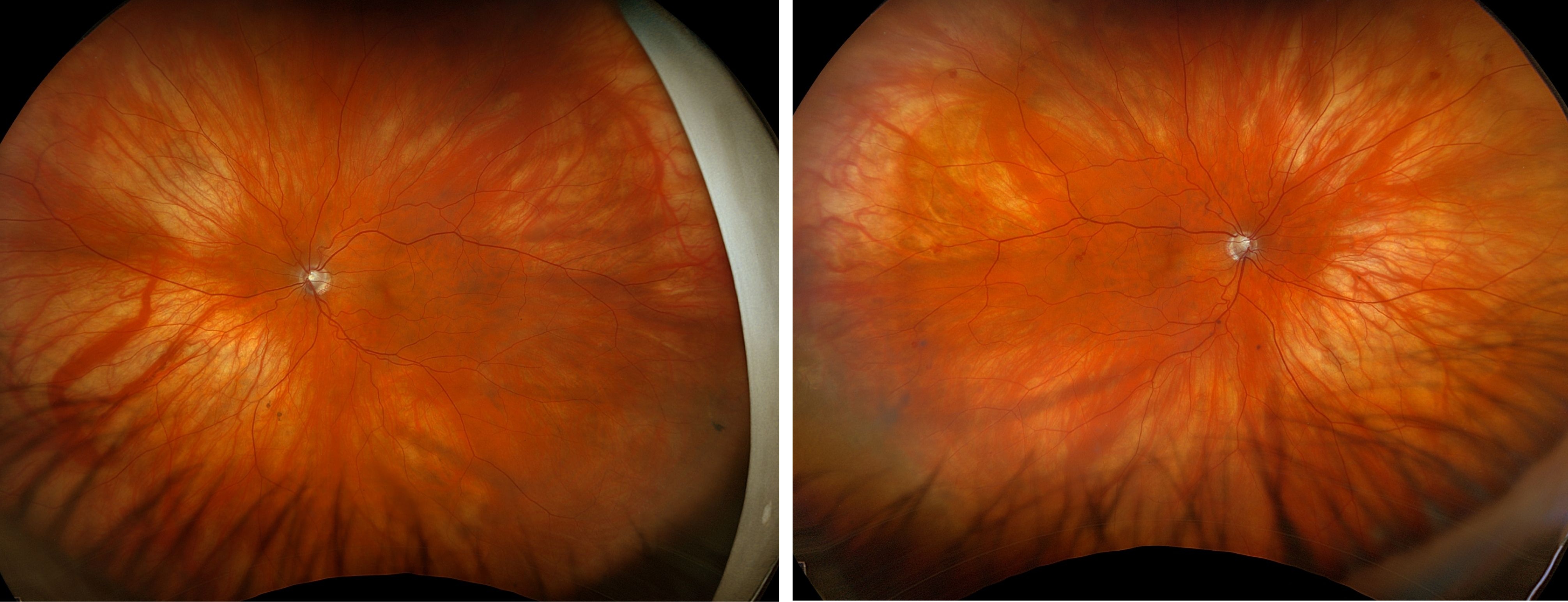 Case Study: Elevated Eye Pressure Findings