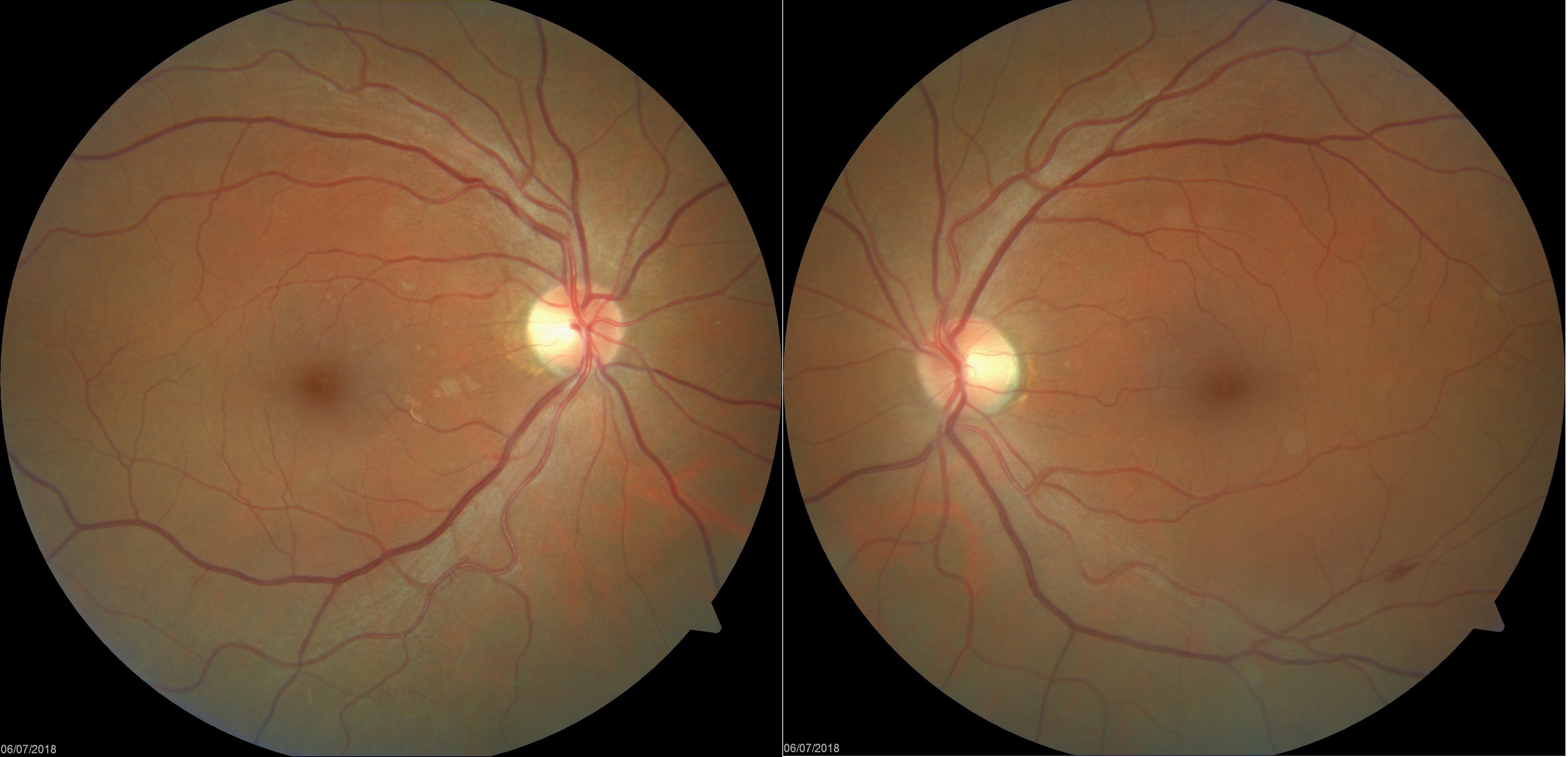 Case Study: Flame Hemorrhage Along Arcade 