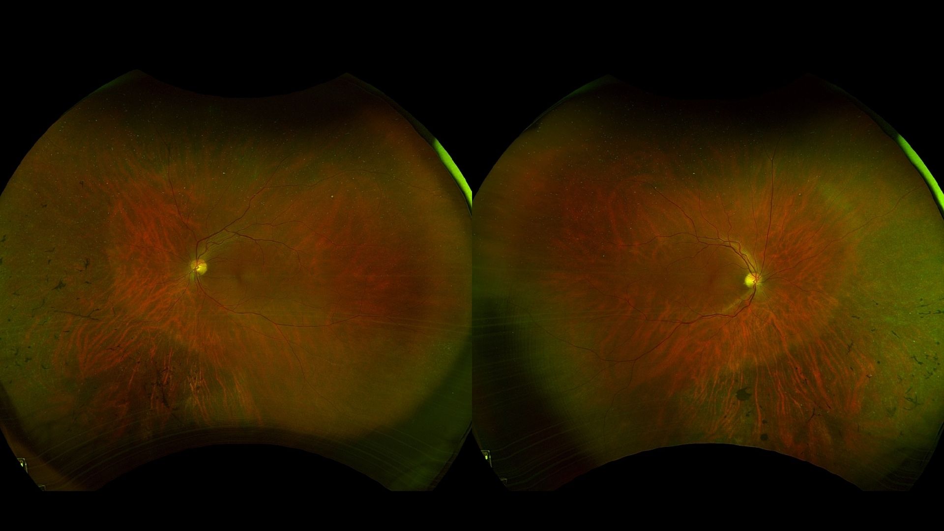 Special Edition - Case Study: Bone Spicules on Fundus Exam