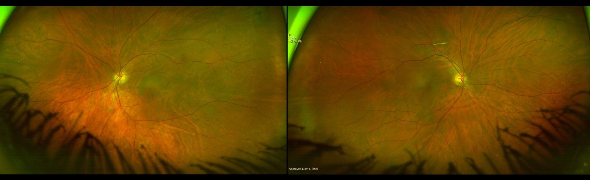 Case Study: Cup-to-Disc Asymmetry With Normal IOP