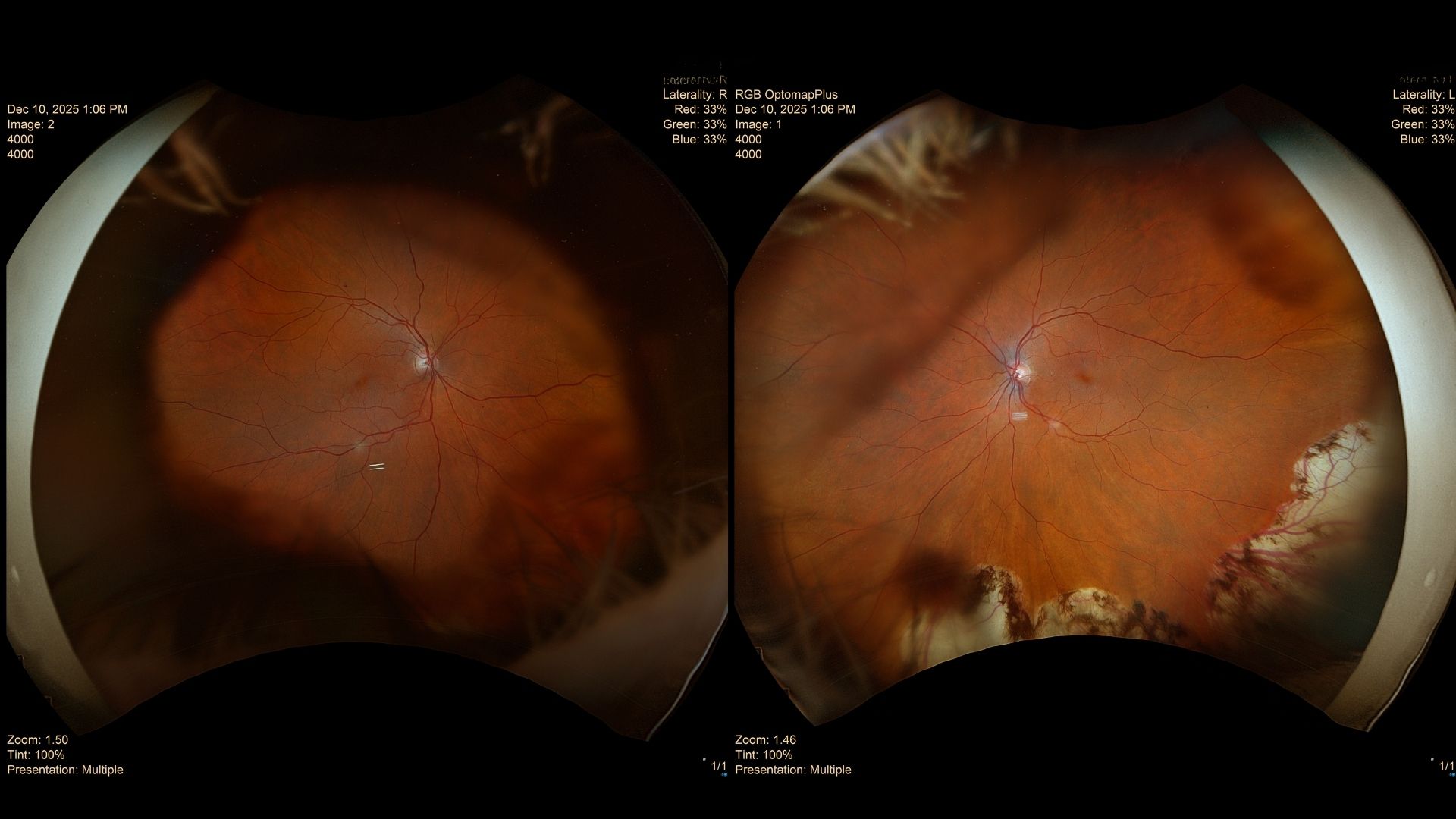 Case Study: Blurred Vision After Retinal Surgery