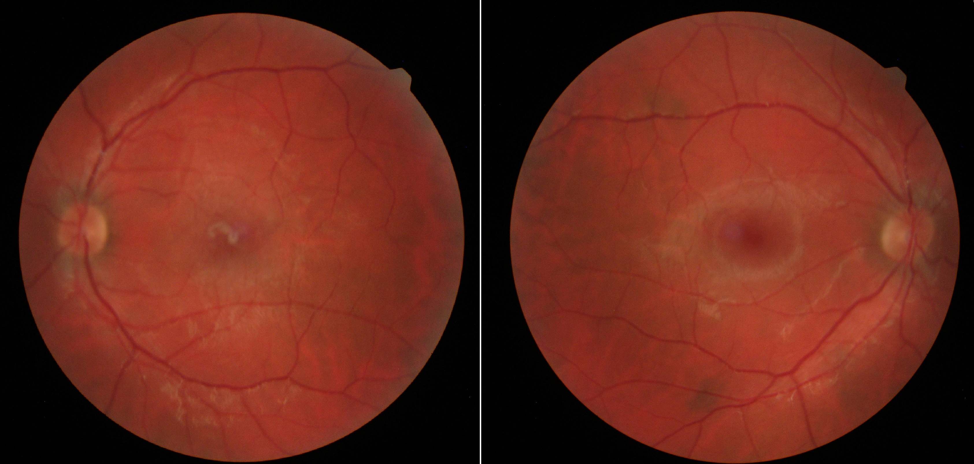 Case Study: Persistent Macular Changes After Trauma 