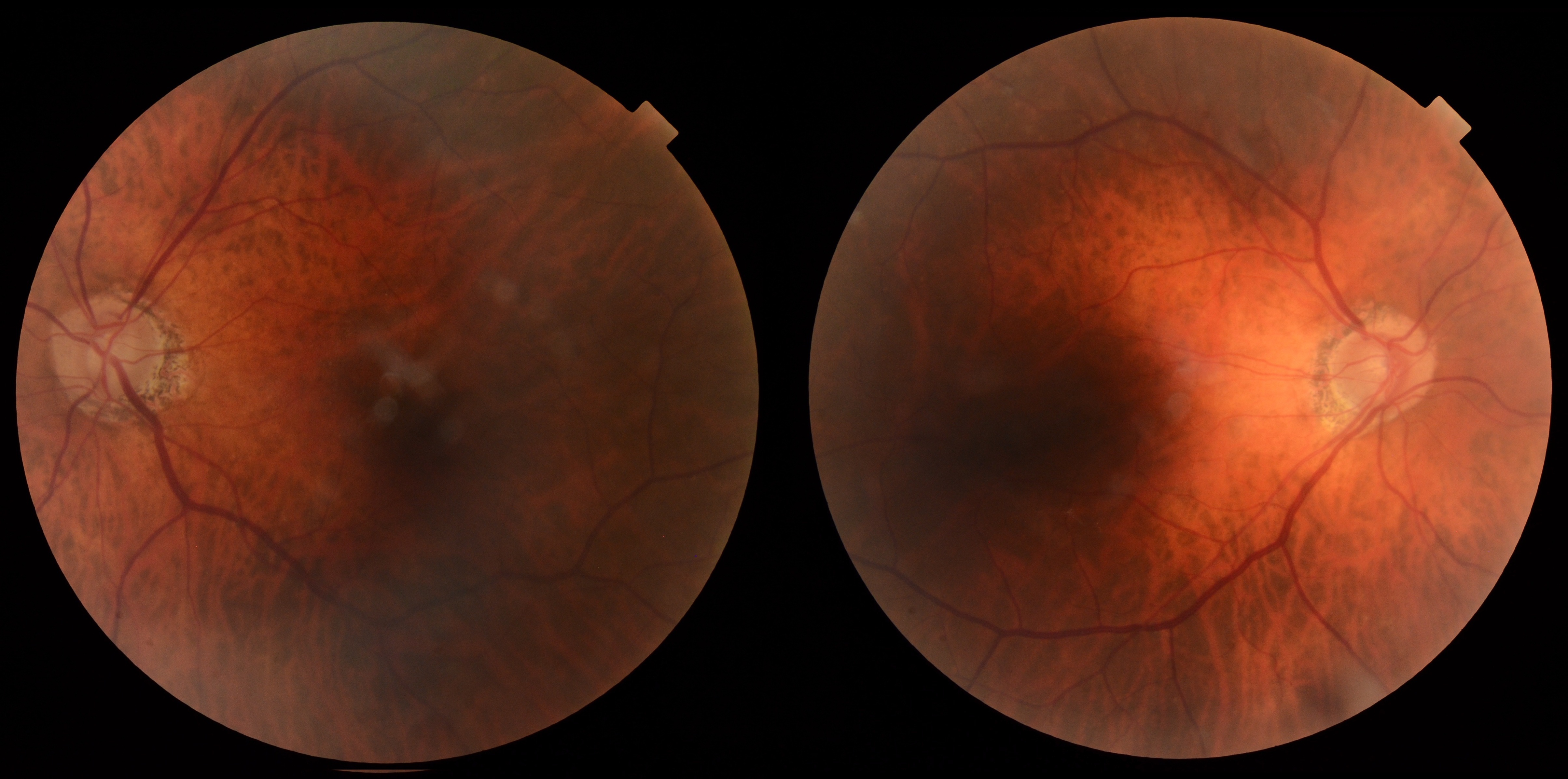 Case Study: Progressive Visual Field Loss 