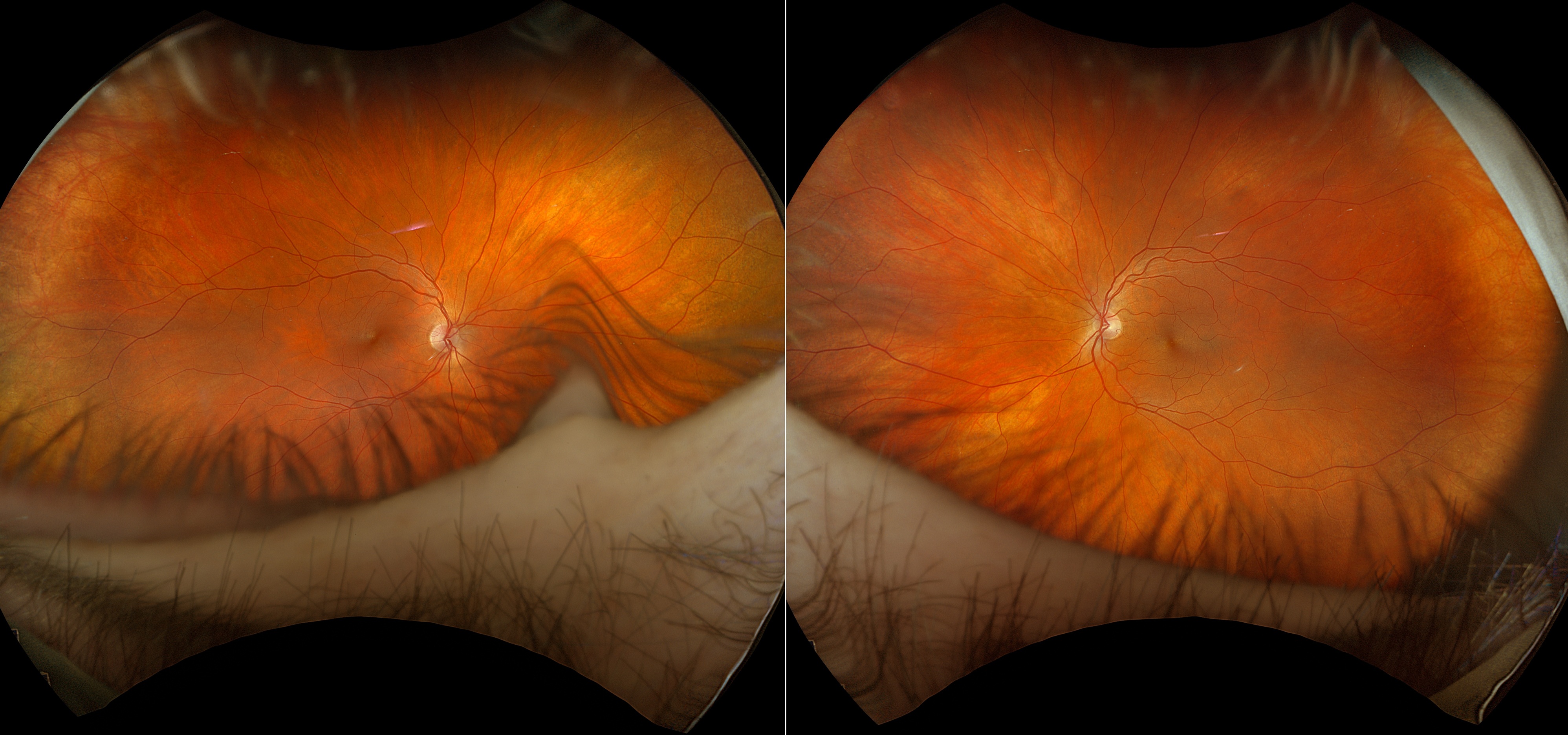 Case Study: Long-Term Retinal Monitoring 