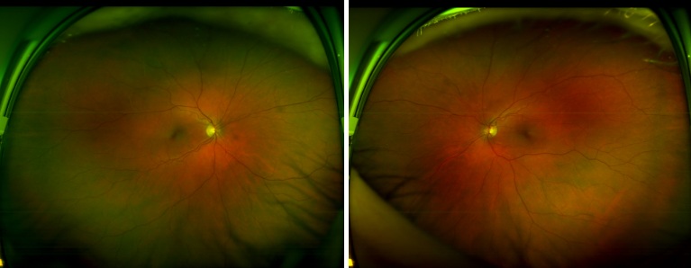 Case Study: Intermittent Ocular Pain and Narrow Angles 