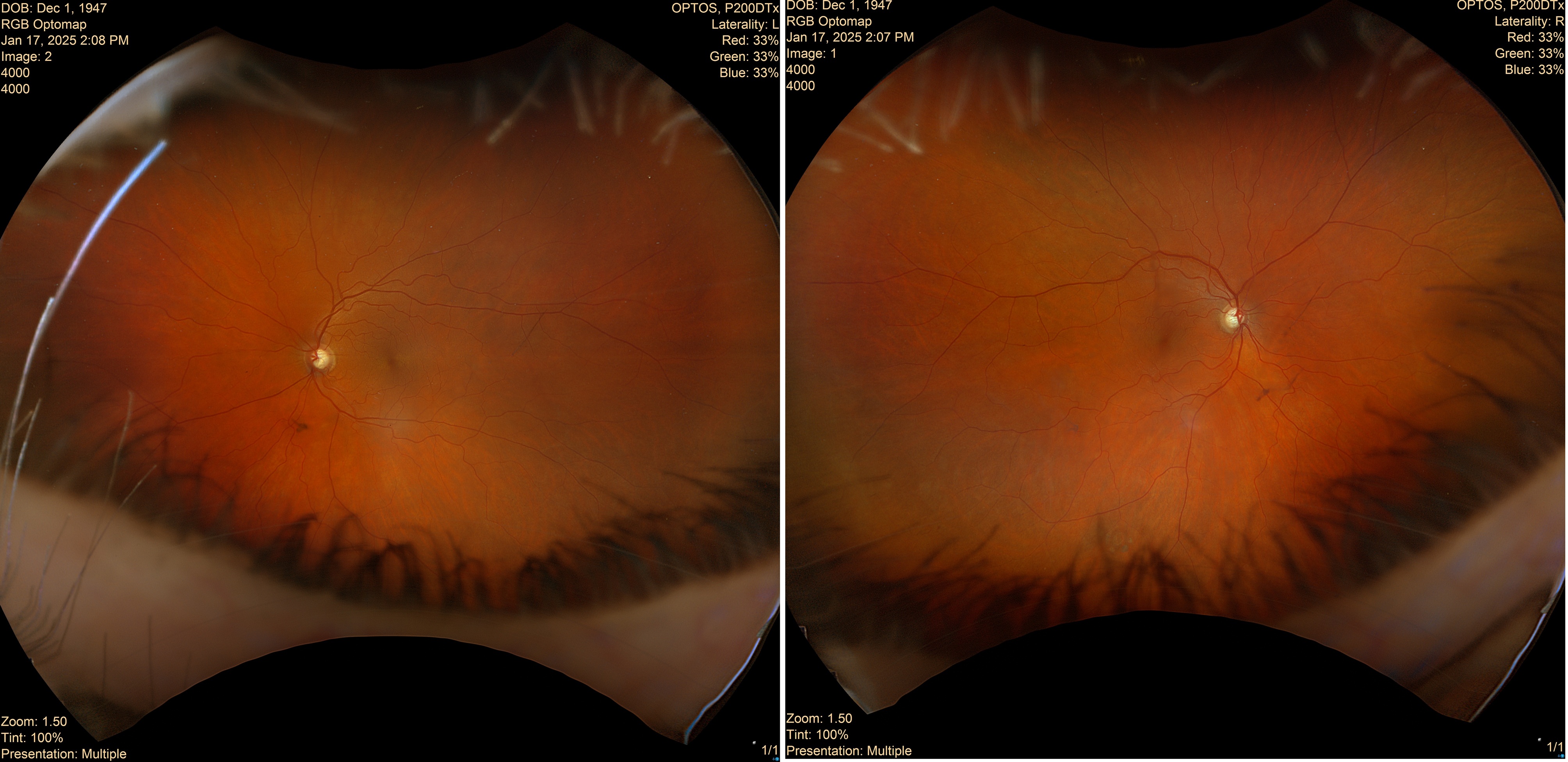 Case Study: Macular Changes With 20/20 Vision